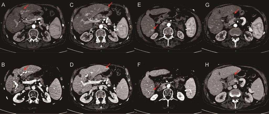 Abdominal contrast-enhanced computed tomography.