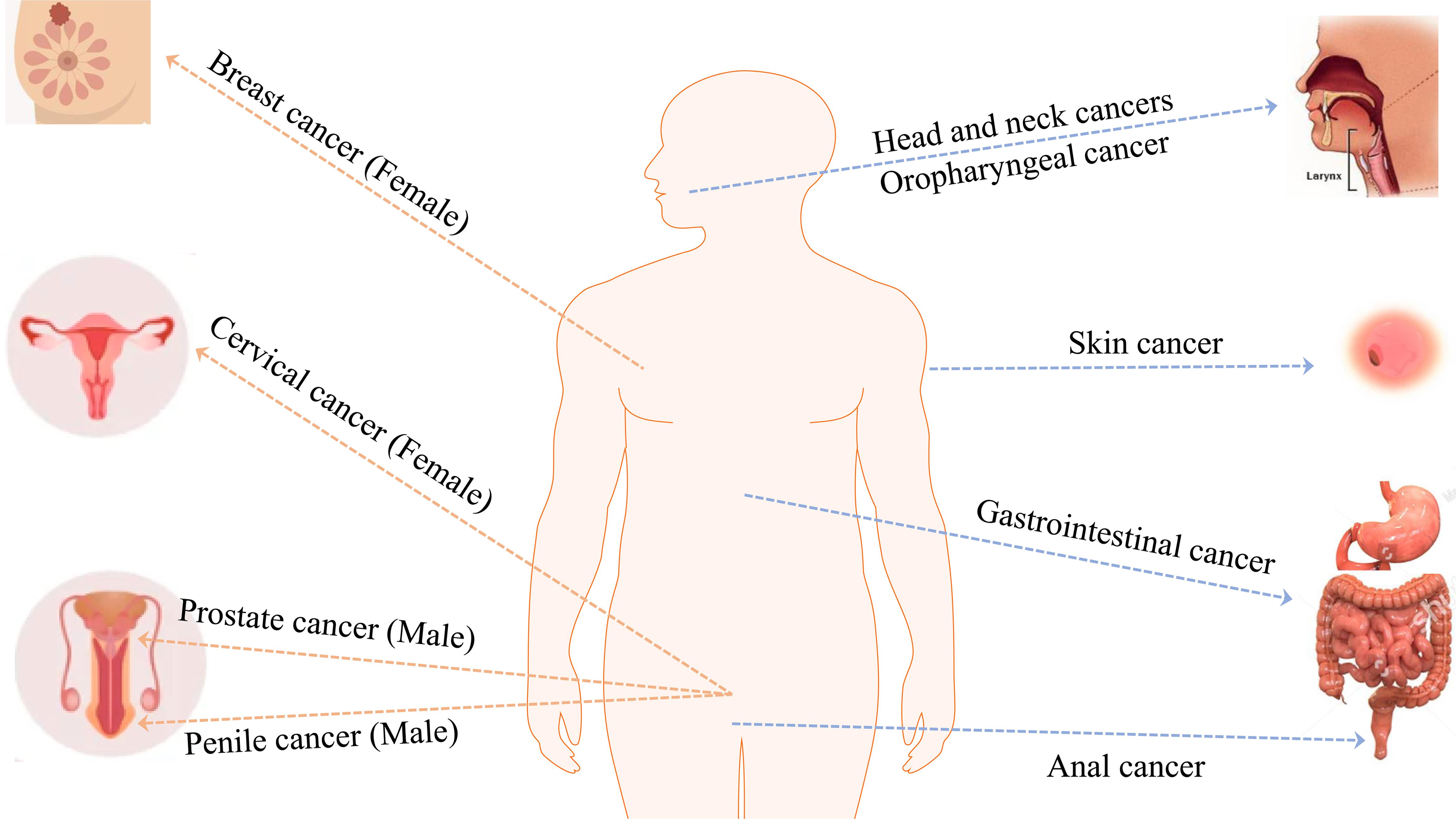 Association of human papillomavirus with various cancers.
