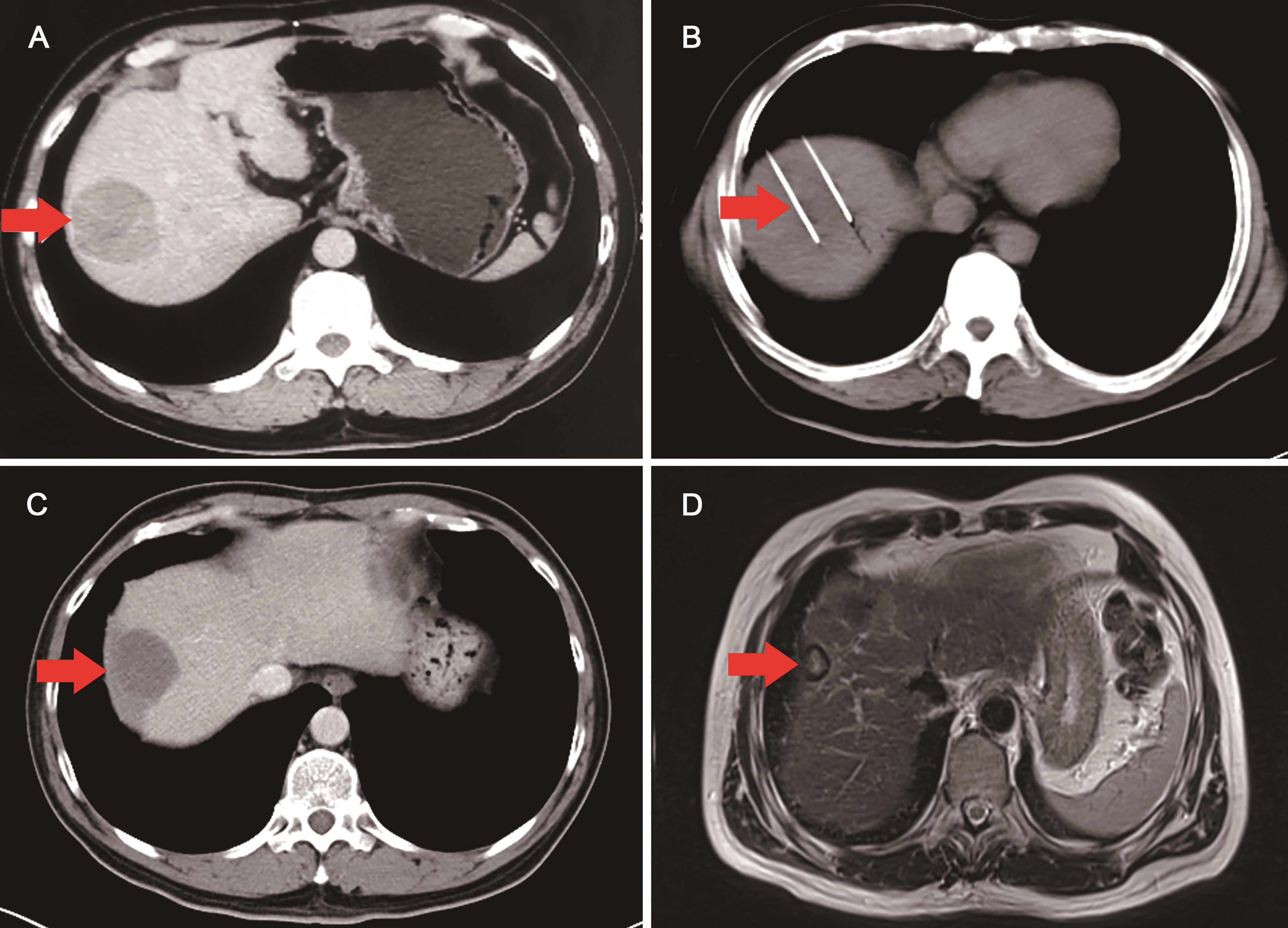 A 49 year-old male with HCC abutting the diaphragm.