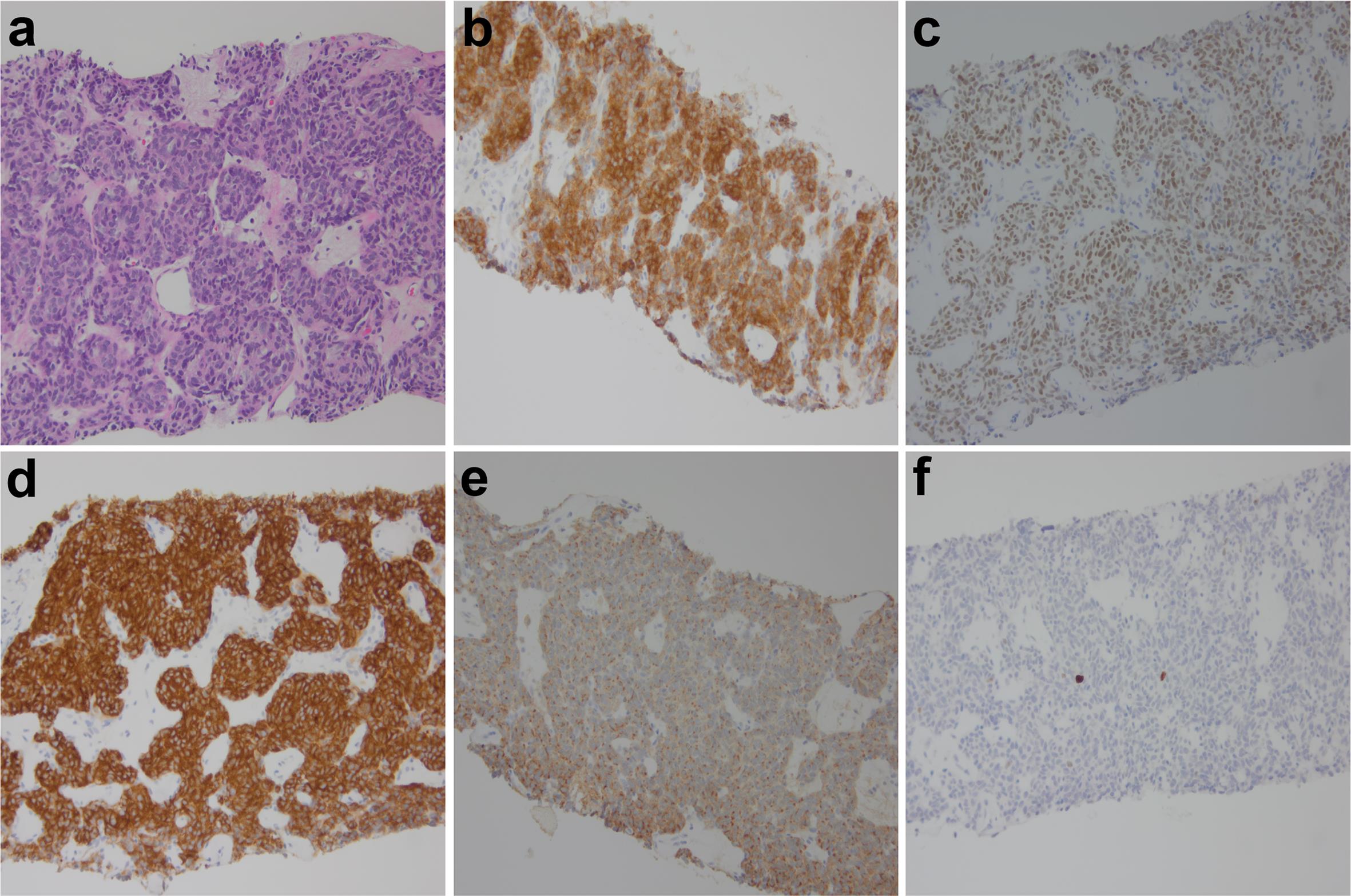 Typical carcinoid tumor.