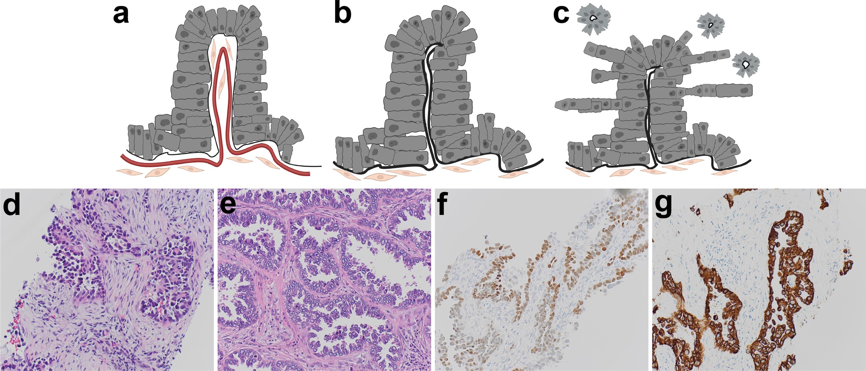 Micropapillary growth pattern and the concept of filigree growth pattern.