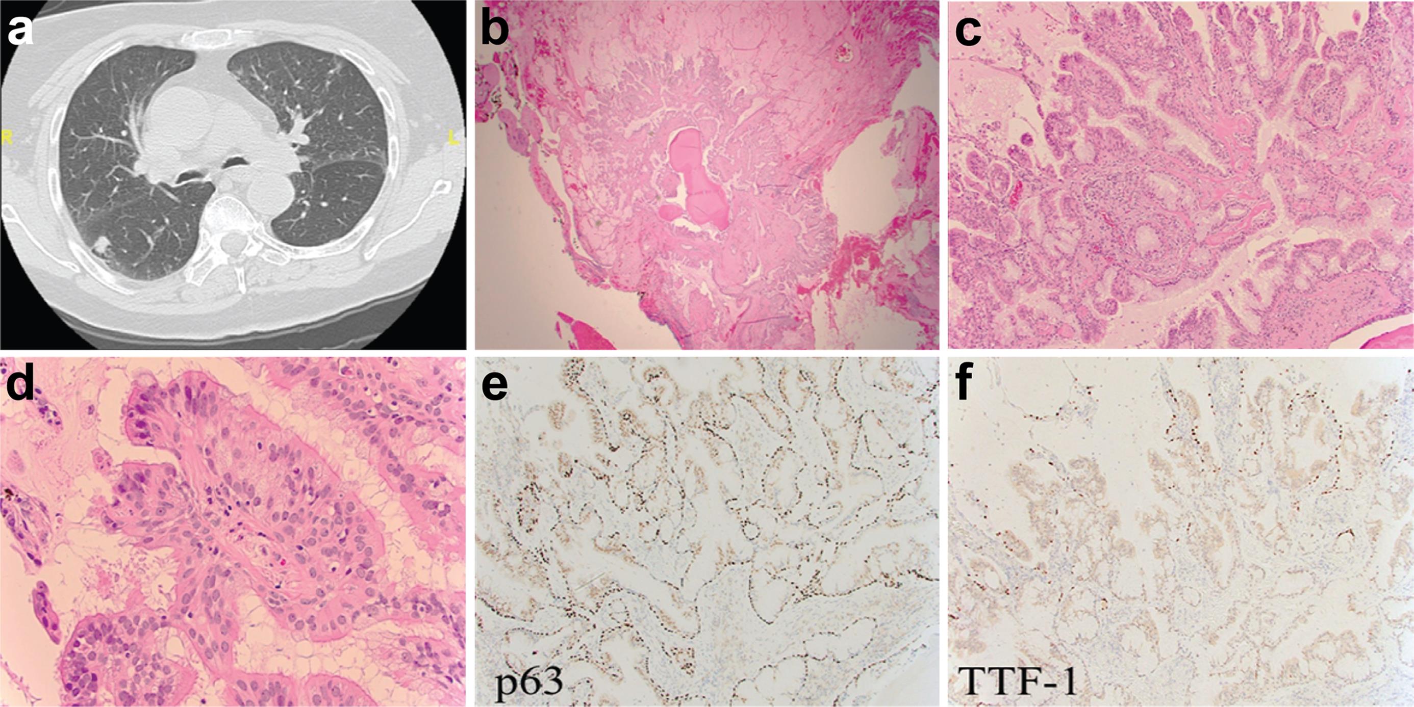 BA/CMPT. (a) BA/CMPT can present as an irregular, solid nodule on computed tomography images.