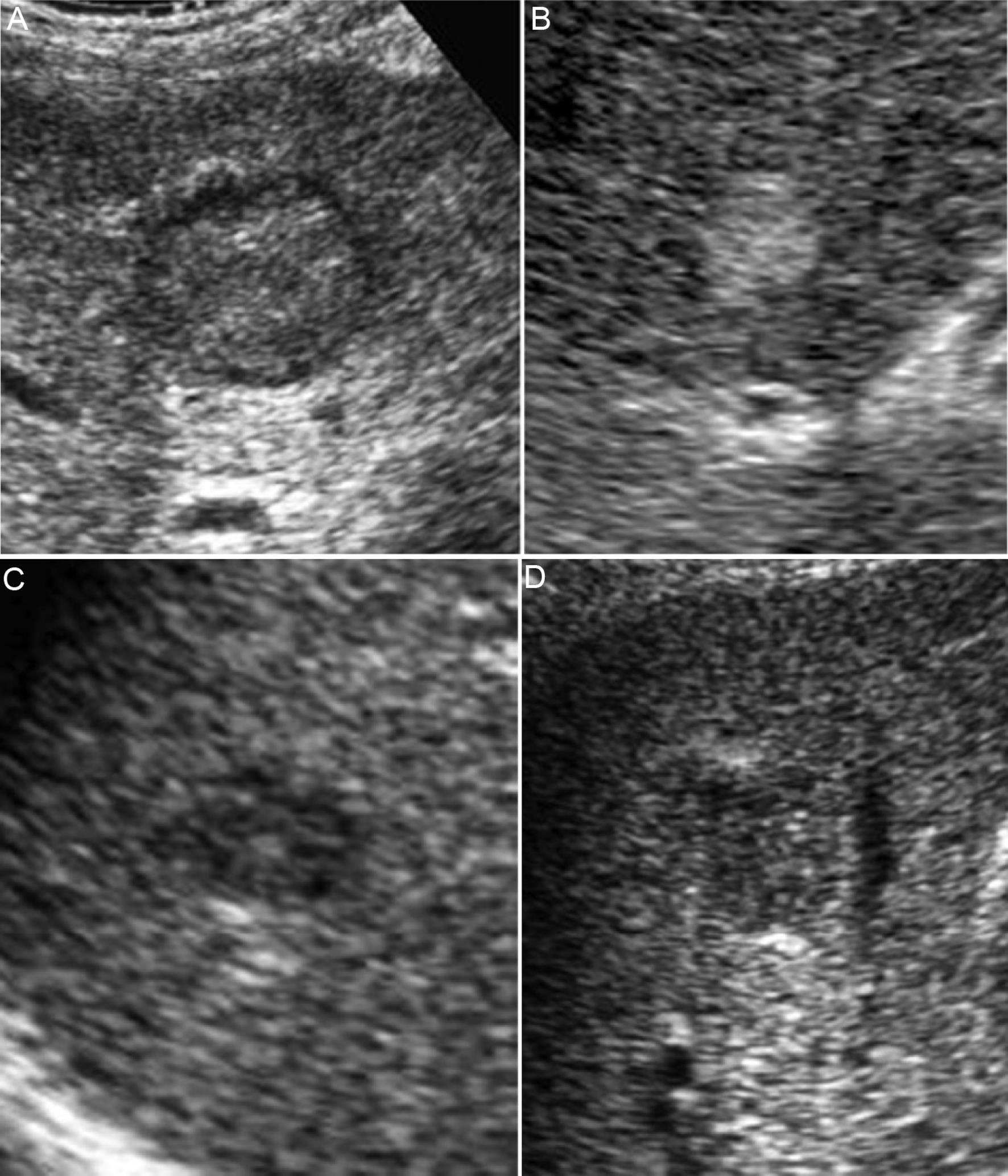 Classification of B-mode ultrasonographic images of small hepatocellular carcinoma.