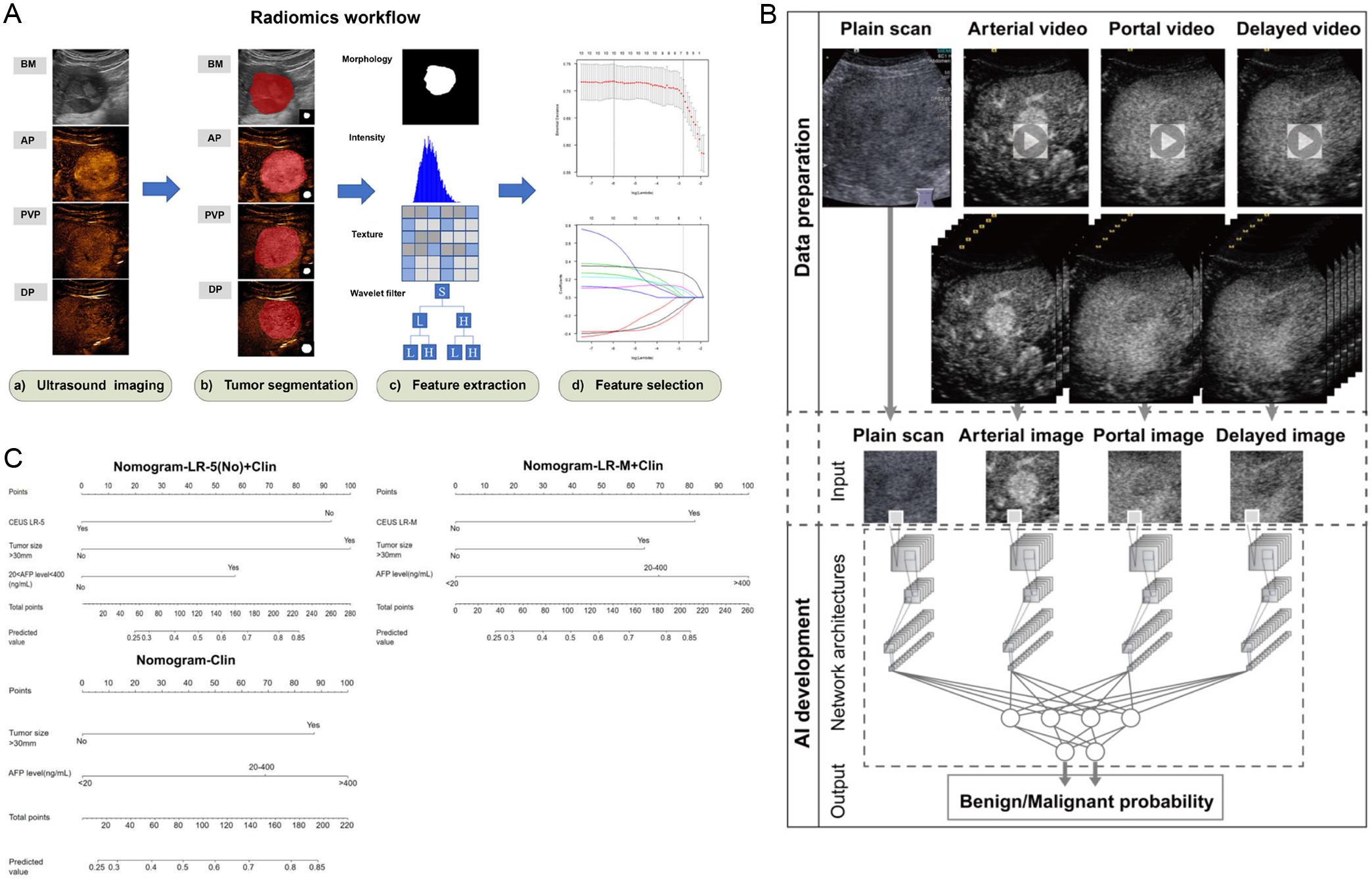 Progress in predicting microvascular invasion in hepatocellular carcinoma using contrast-enhanced ultrasound.