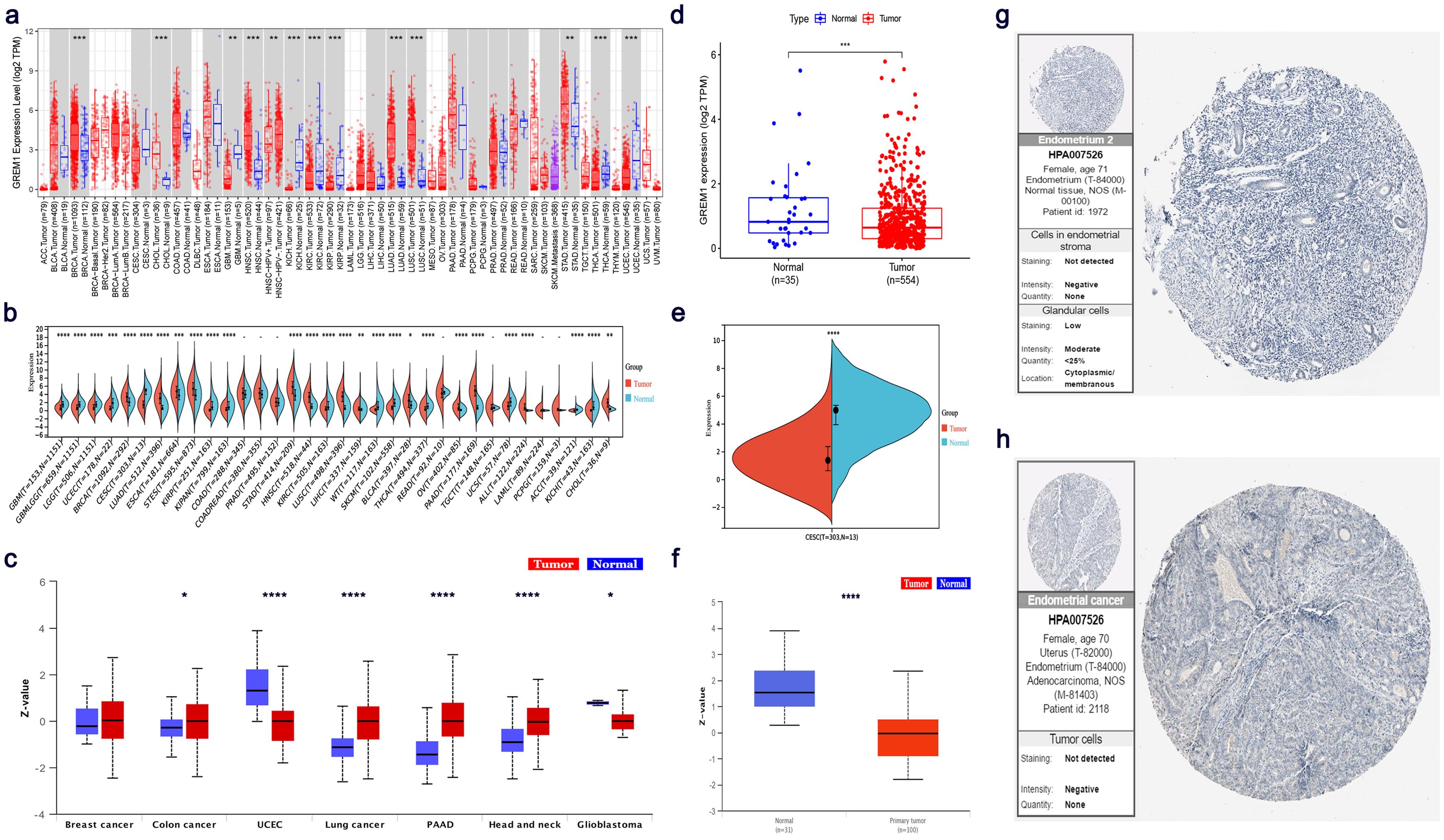 Expression pattern of GREM1 at the pan-caner level.