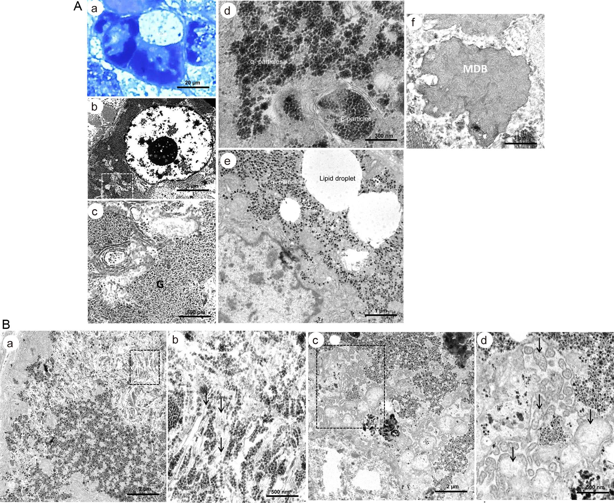 Serial semithin resin sections of cirrhotic liver from patients with HBV observed by microscopy. Ultrastructural findings.