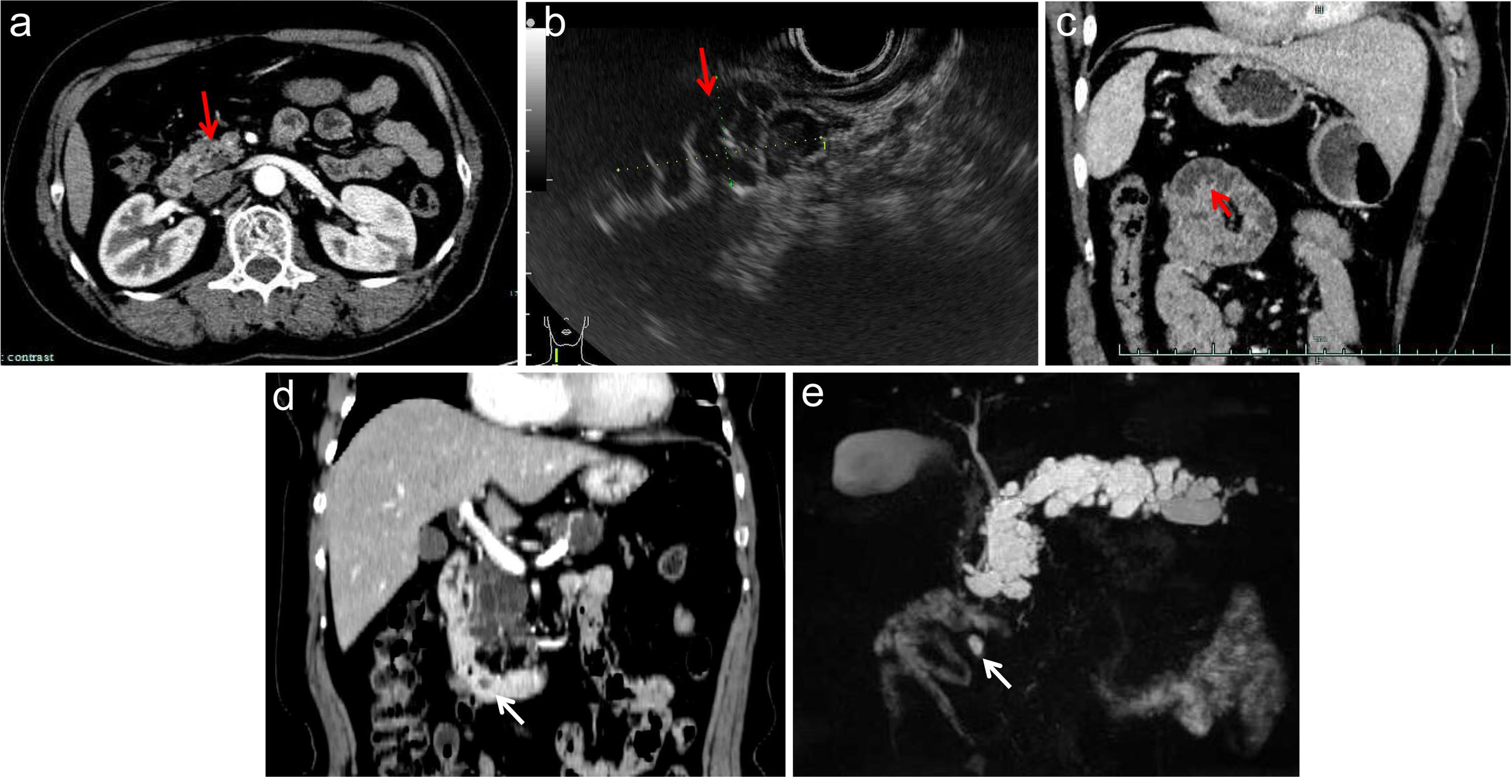 Imaging findings of intraductal papillary mucinous neoplasms (IPMNs) in the orthotopic pancreas and ectopic pancreas in patients One (a-c) and Two (d, e).