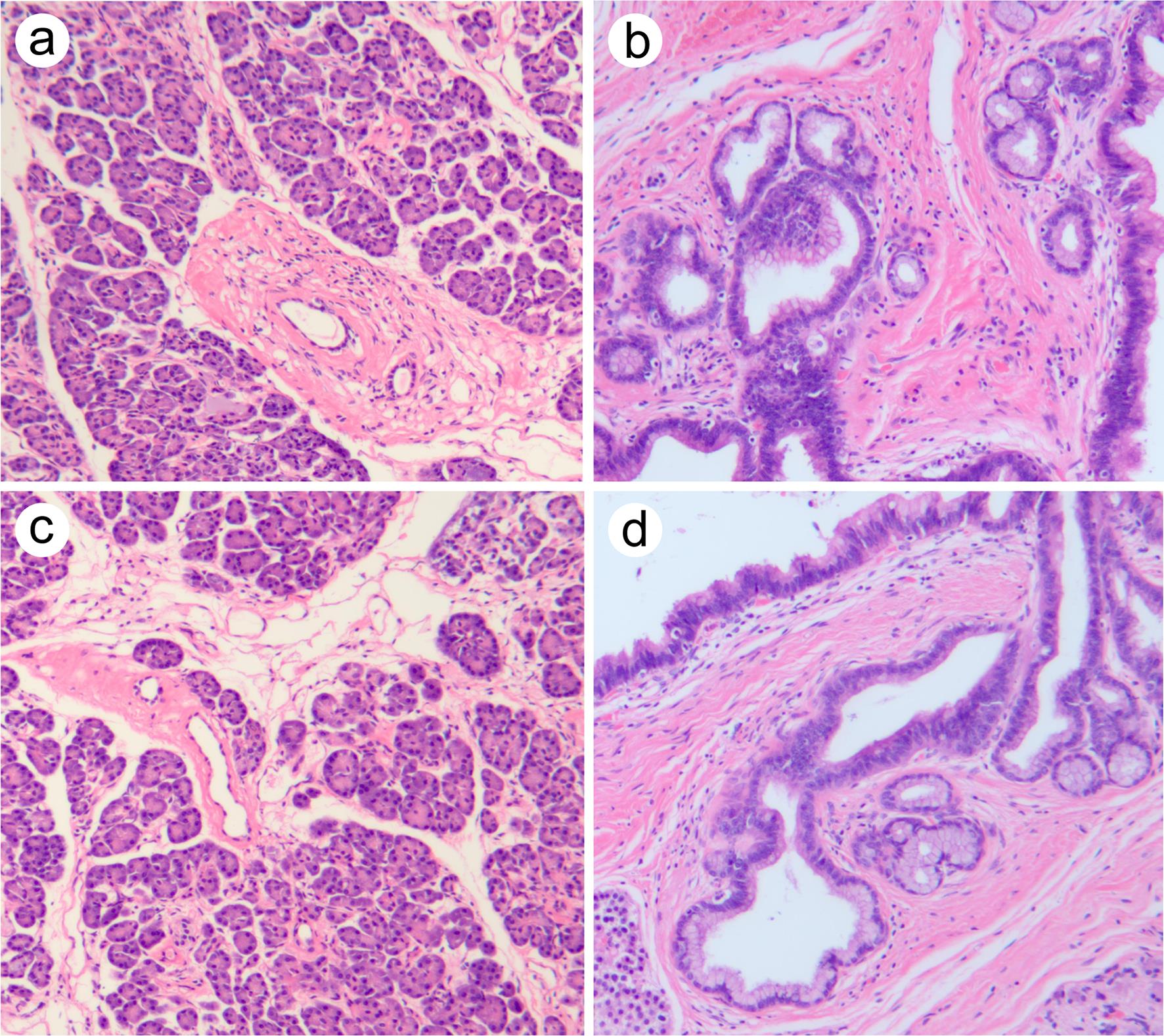 Histologic examinations of the ectopic pancreas in Patient One (a, b) and Patient Two (c, d).