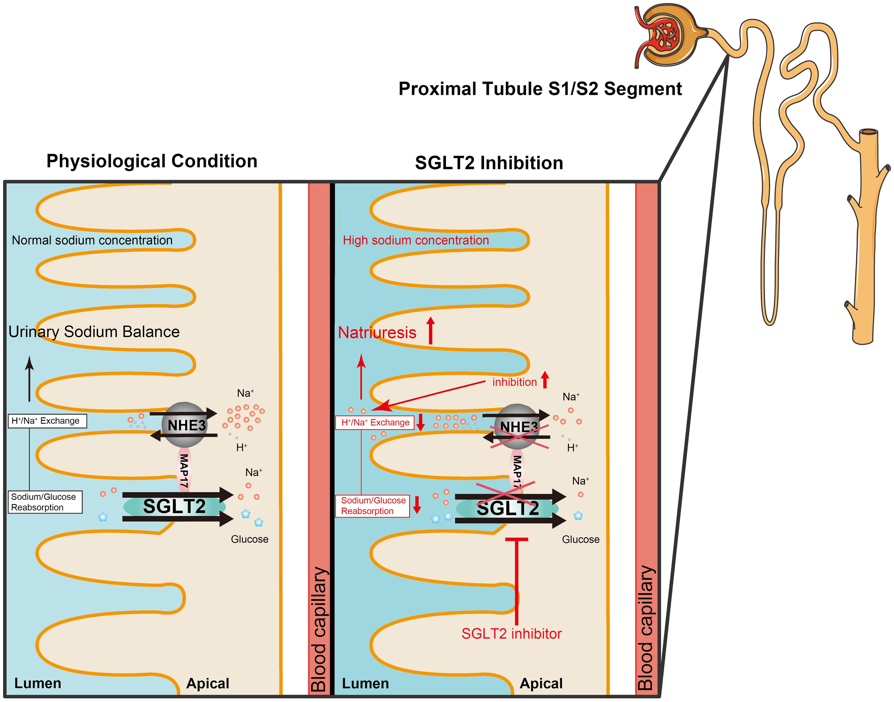 Molecular mechanisms for the SGLT2 inhibitor–mediated reduction in proximal tubular sodium reabsorption.