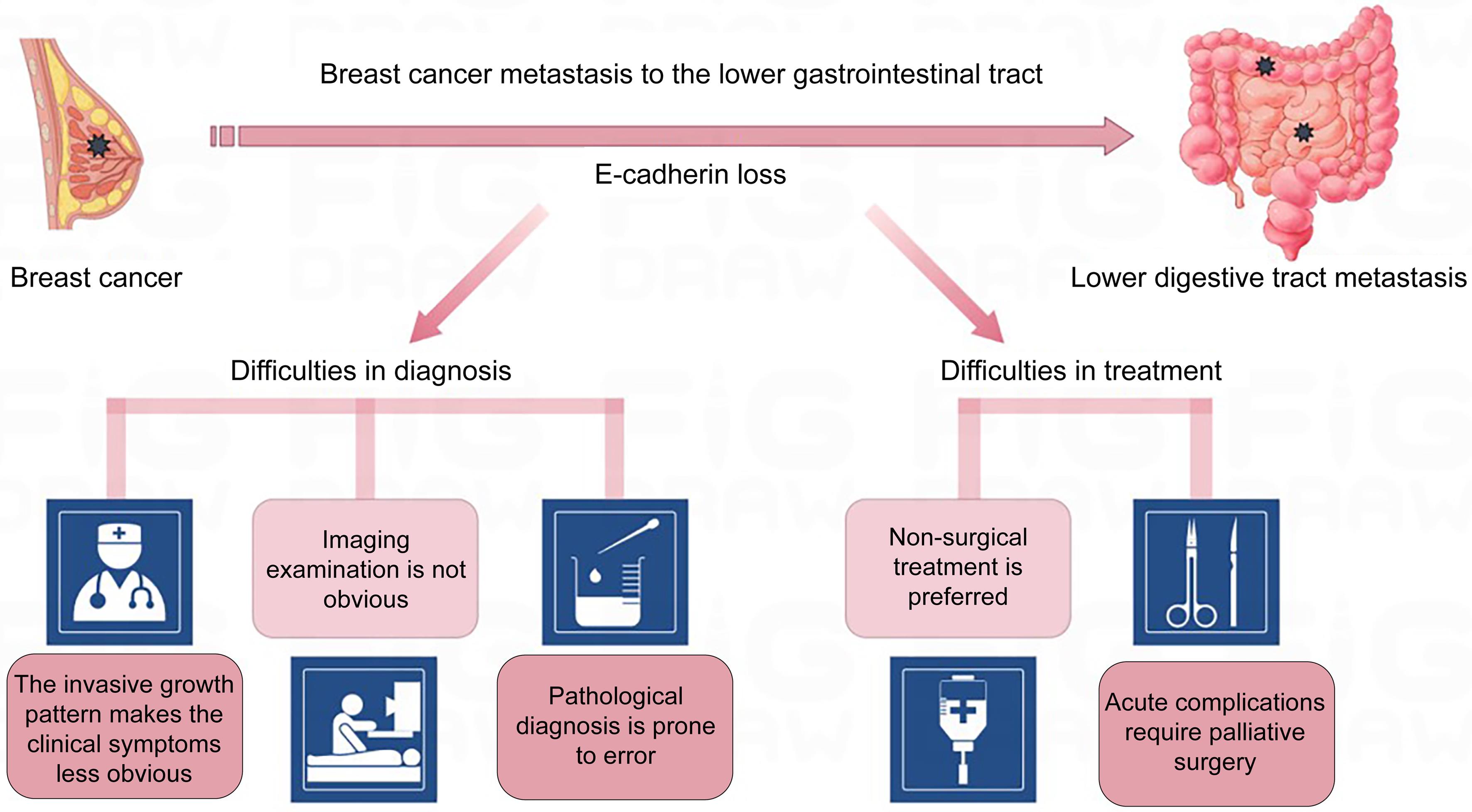 Breast cancer metastases to the lower digestive tract.