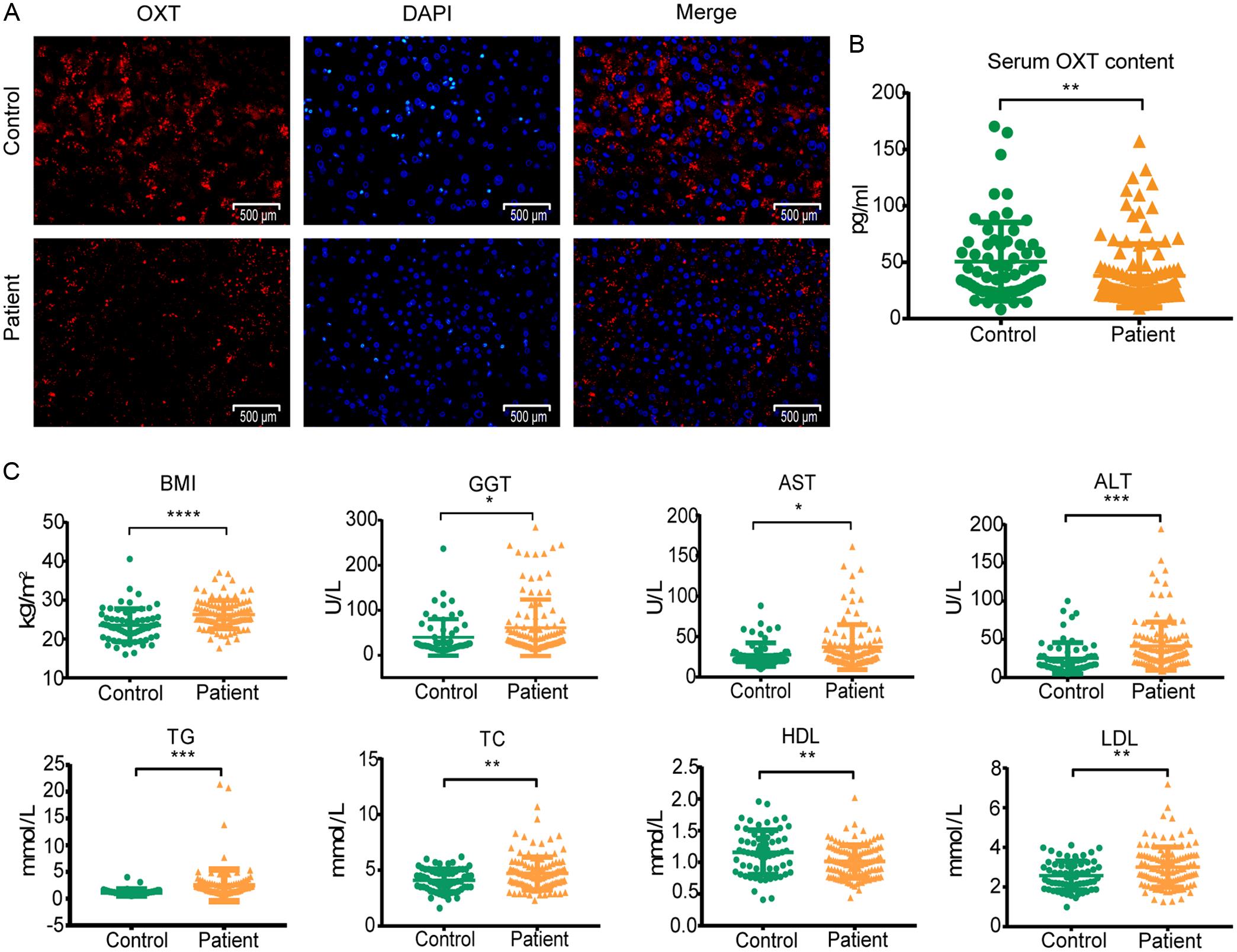 Expression levels of OXT in MASLD patients.