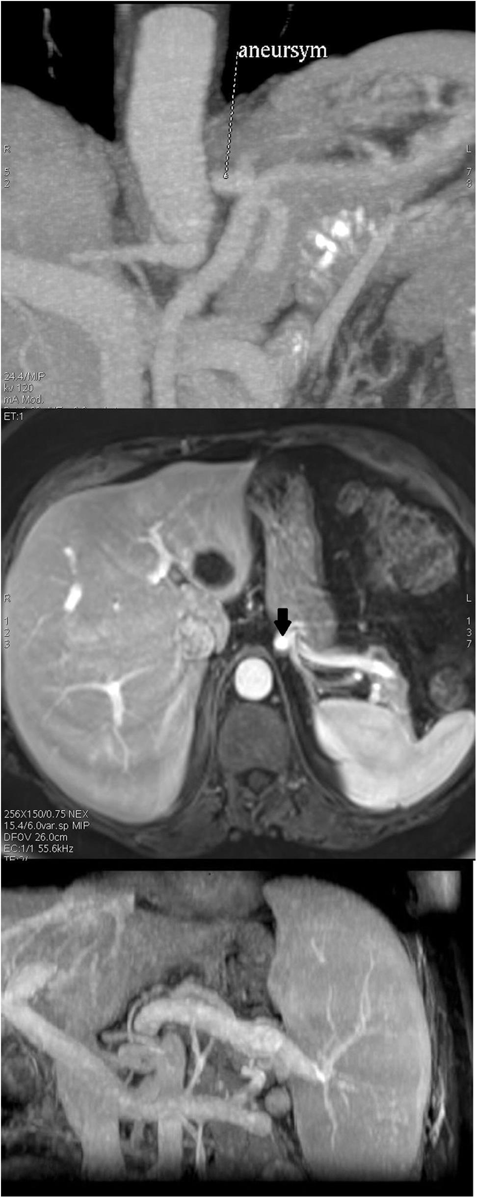 Splenic artery aneurysm as seen on a CT scan of the abdomen under maximum intensity projection (MIP) (topmost image), a splenic artery aneurysm on MRI of the abdomen with contrast (marked by the arrow) (center image), and a spontaneous splenorenal shunt as seen in a CT scan of the abdomen with contrast (bottom image).