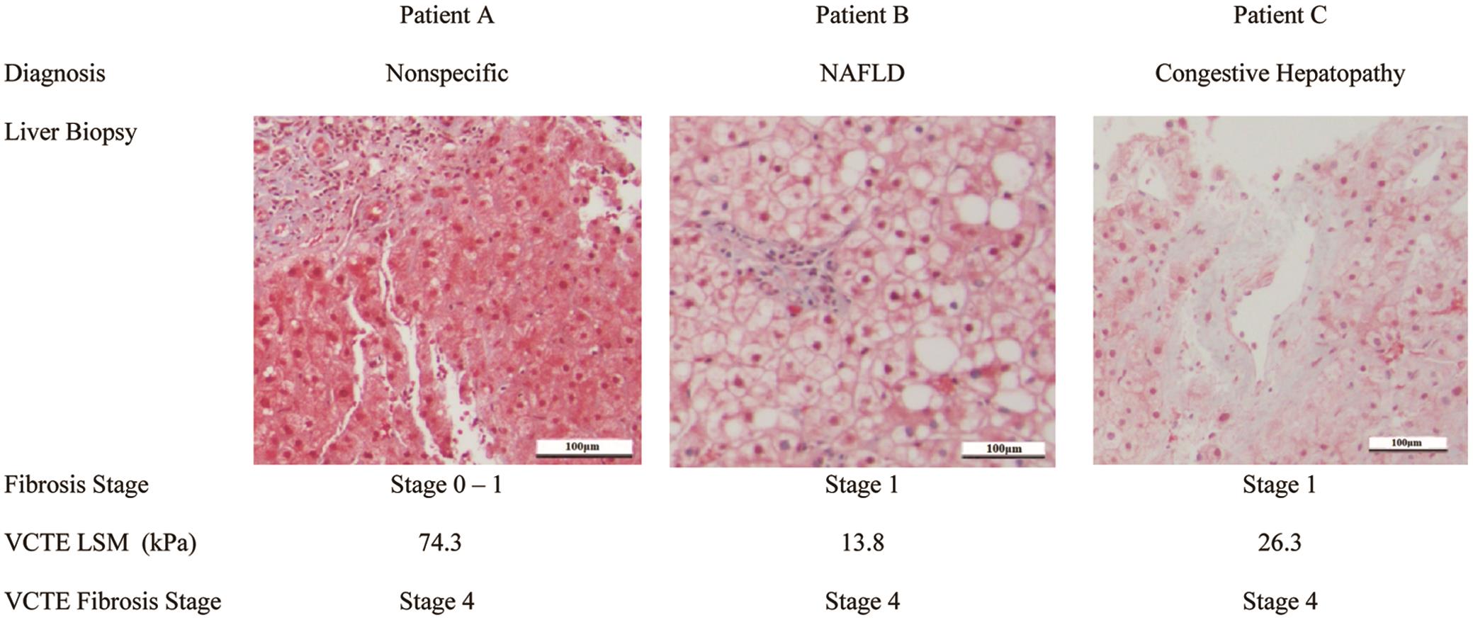 Vibration Controlled Transient Elastography For Assessment Of Liver