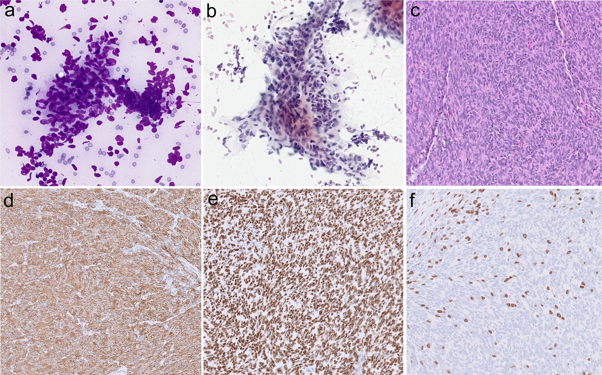 Morphology of type A thymoma.