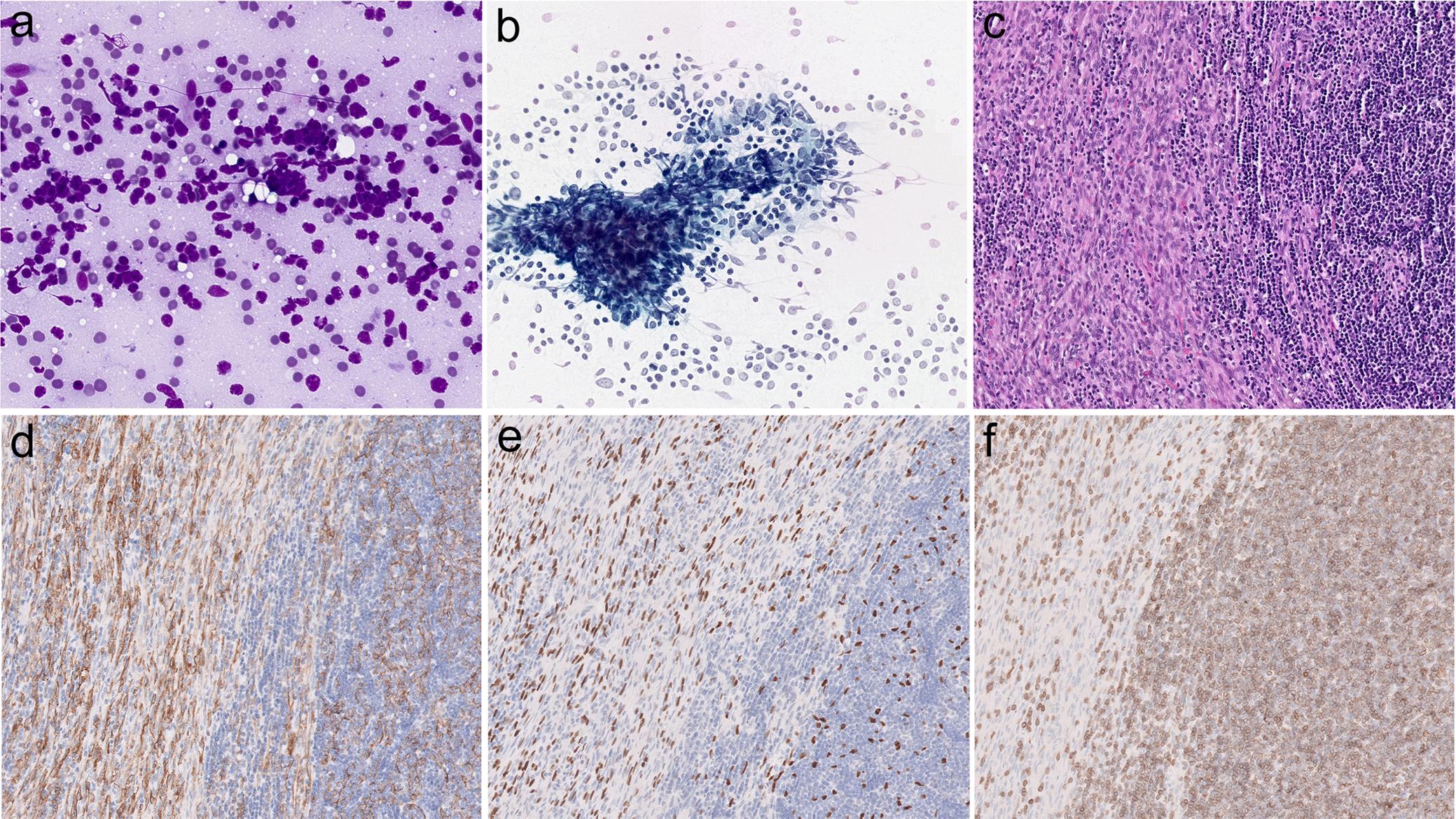 Morphology of type AB thymoma.