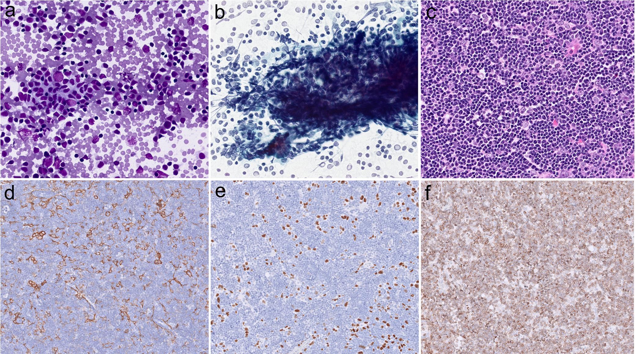 Morphology of type B1 thymoma.