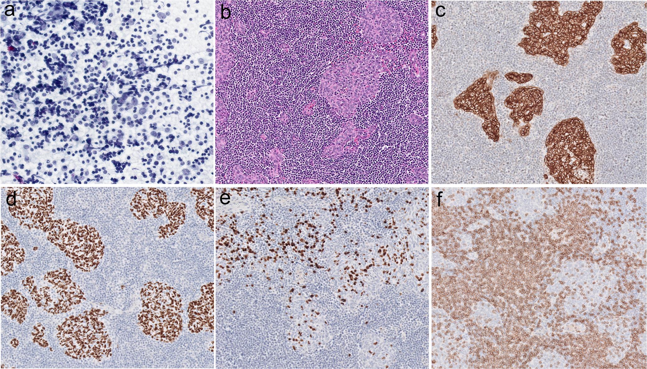 Morphology of type B2 thymoma.