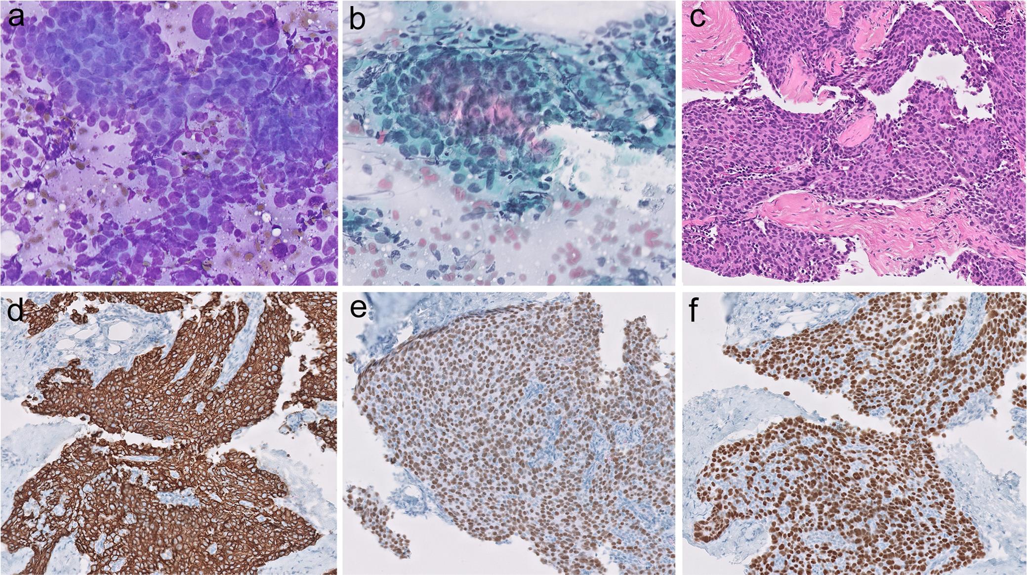 Morphology of type B3 thymoma.