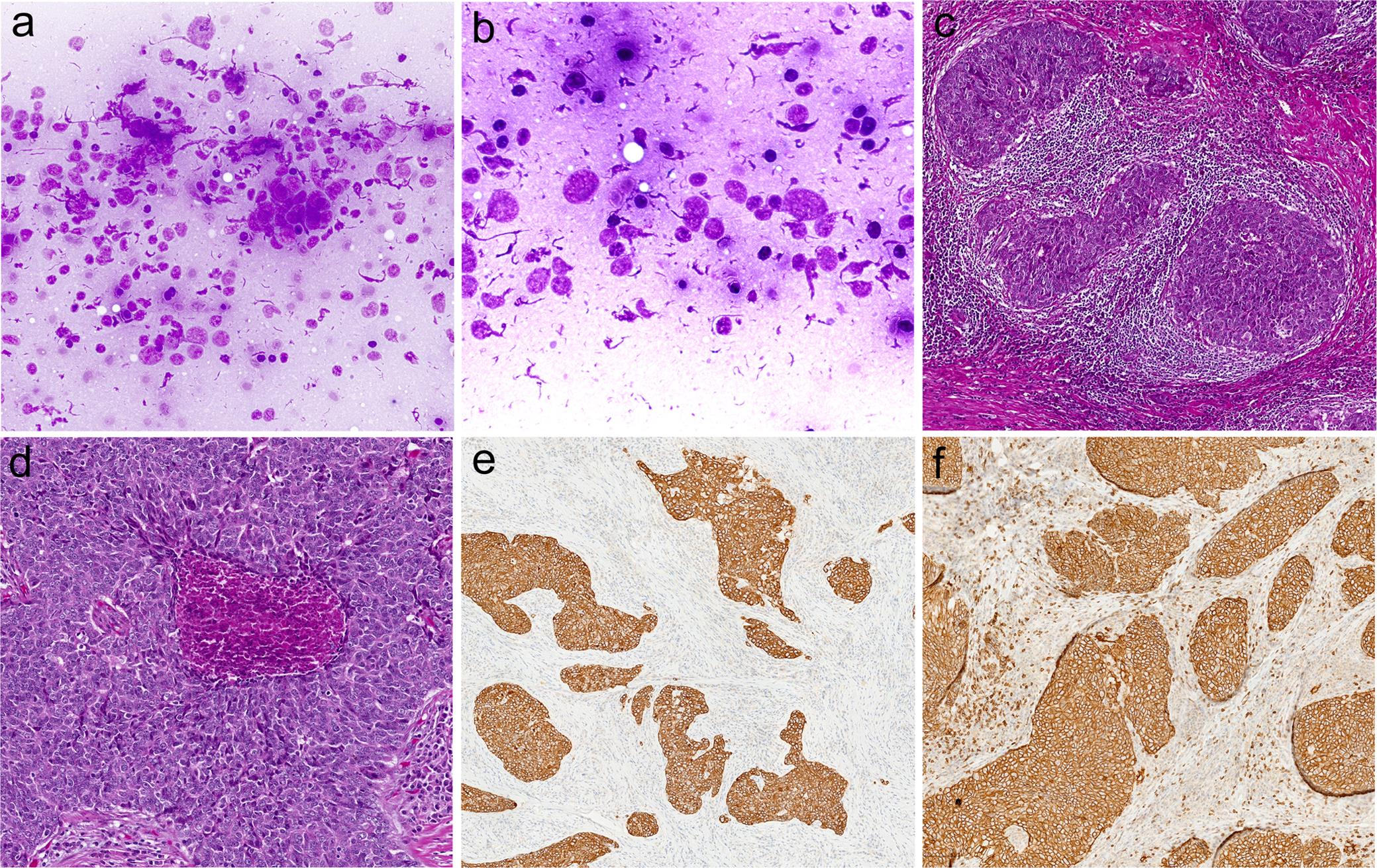 Morphology of thymic carcinoma (lymphoepithelioma-like).