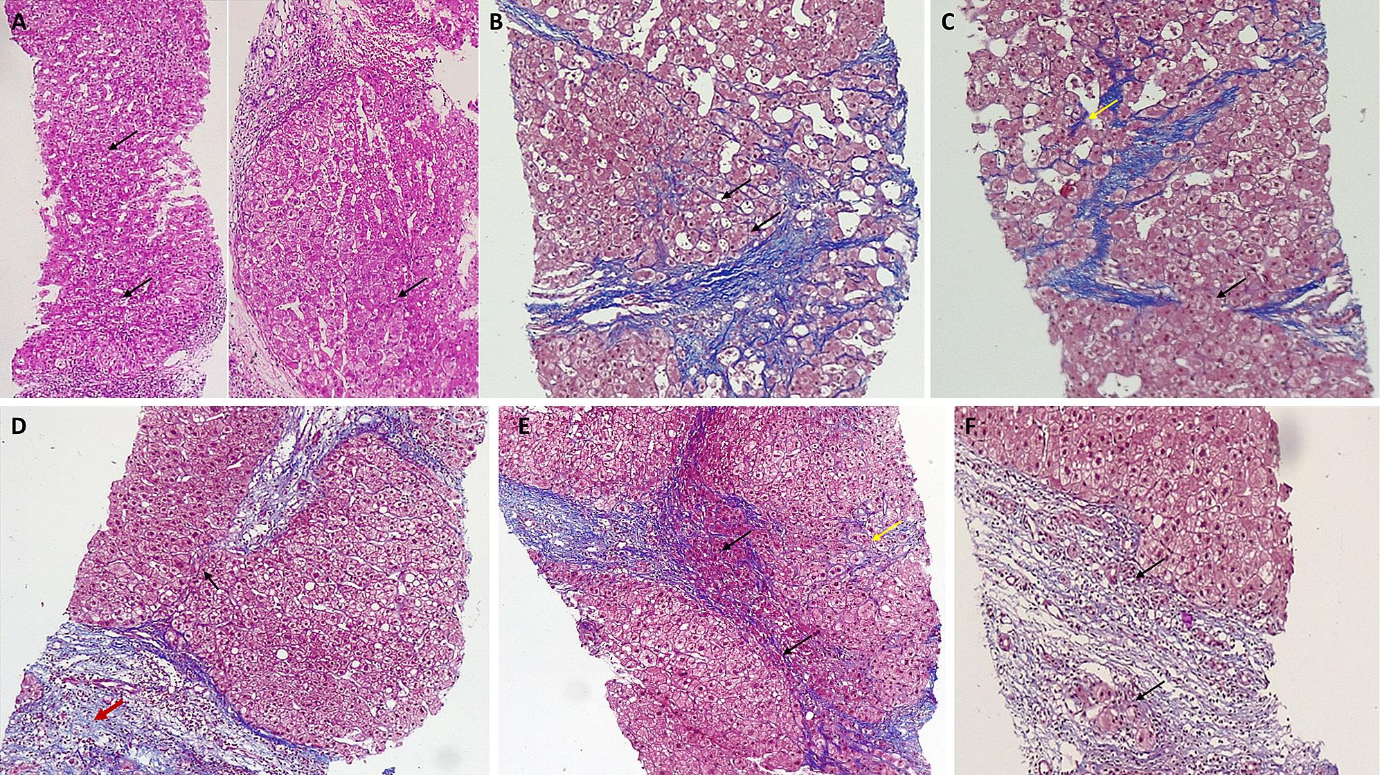Percutaneous liver biopsy features showing various components of the hepatic repair complex in patients with nonalcoholic steatohepatitis-related cirrhosis after a 12-week course of pirfenidone.