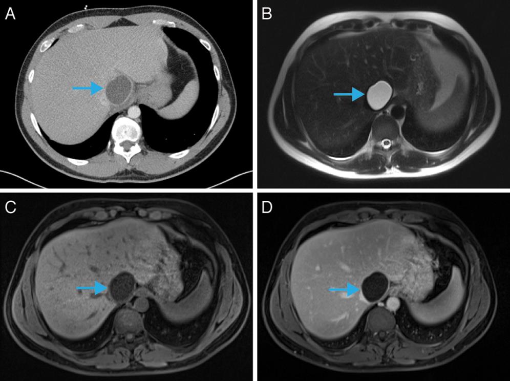 Unilocular hepatic hydatid cyst (blue arrow) on CT and MRI.