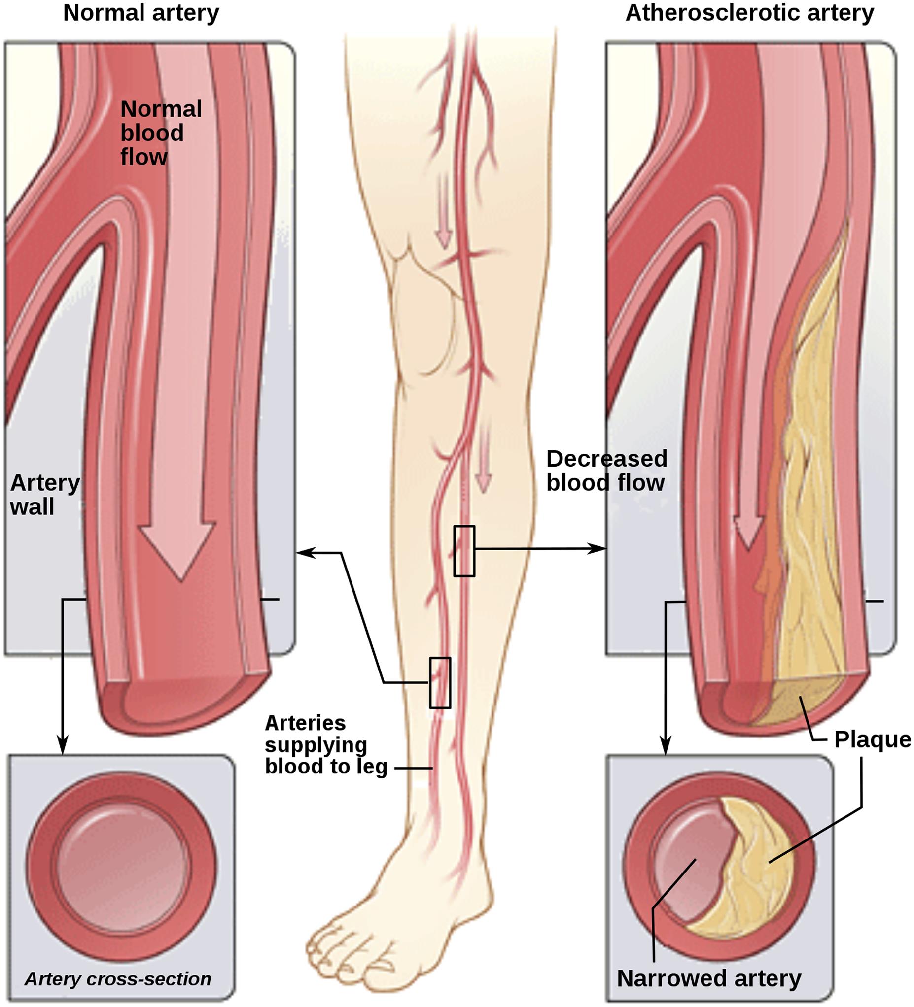 Peripheral arterial disease (PAD).