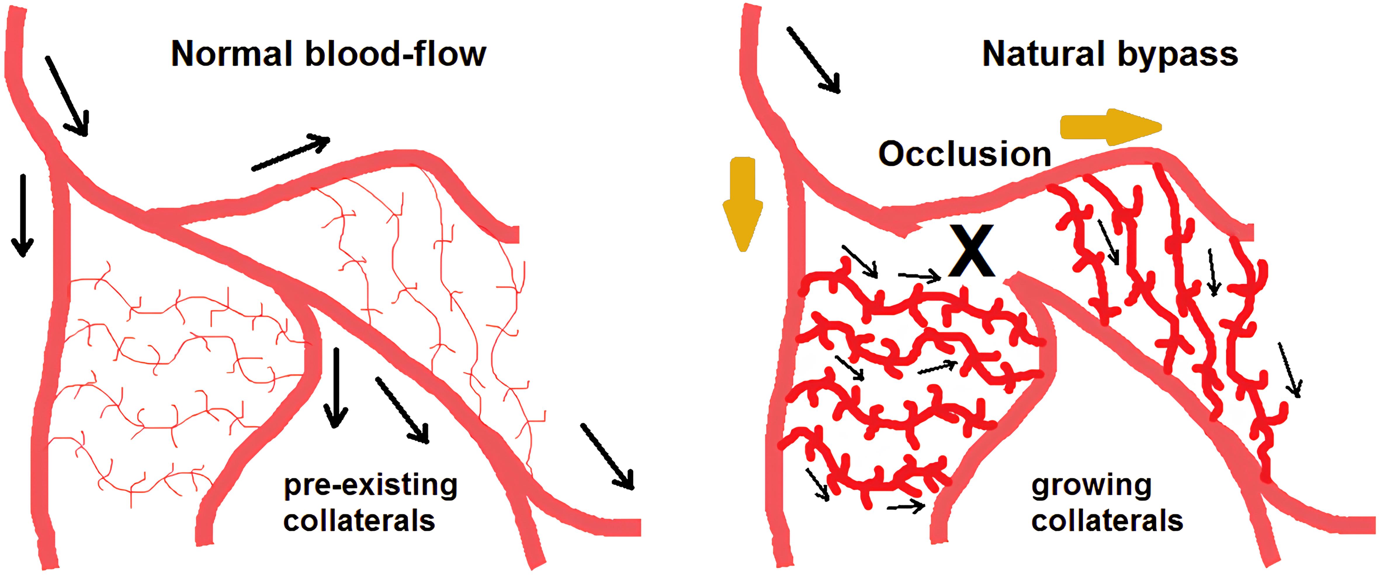 Collateral artery formation (arteriogenesis).