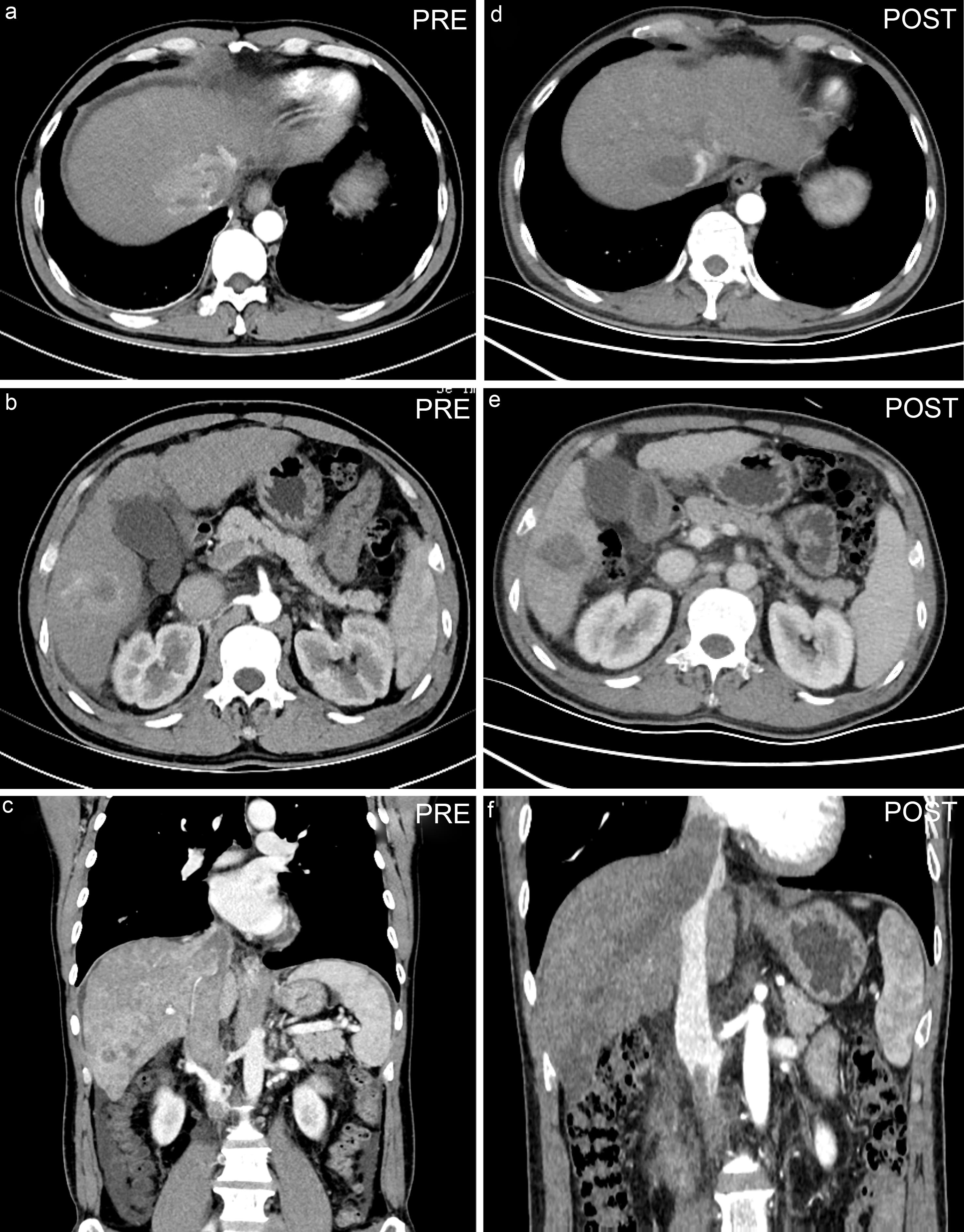 Preoperative and 3-month postoperative CT images.