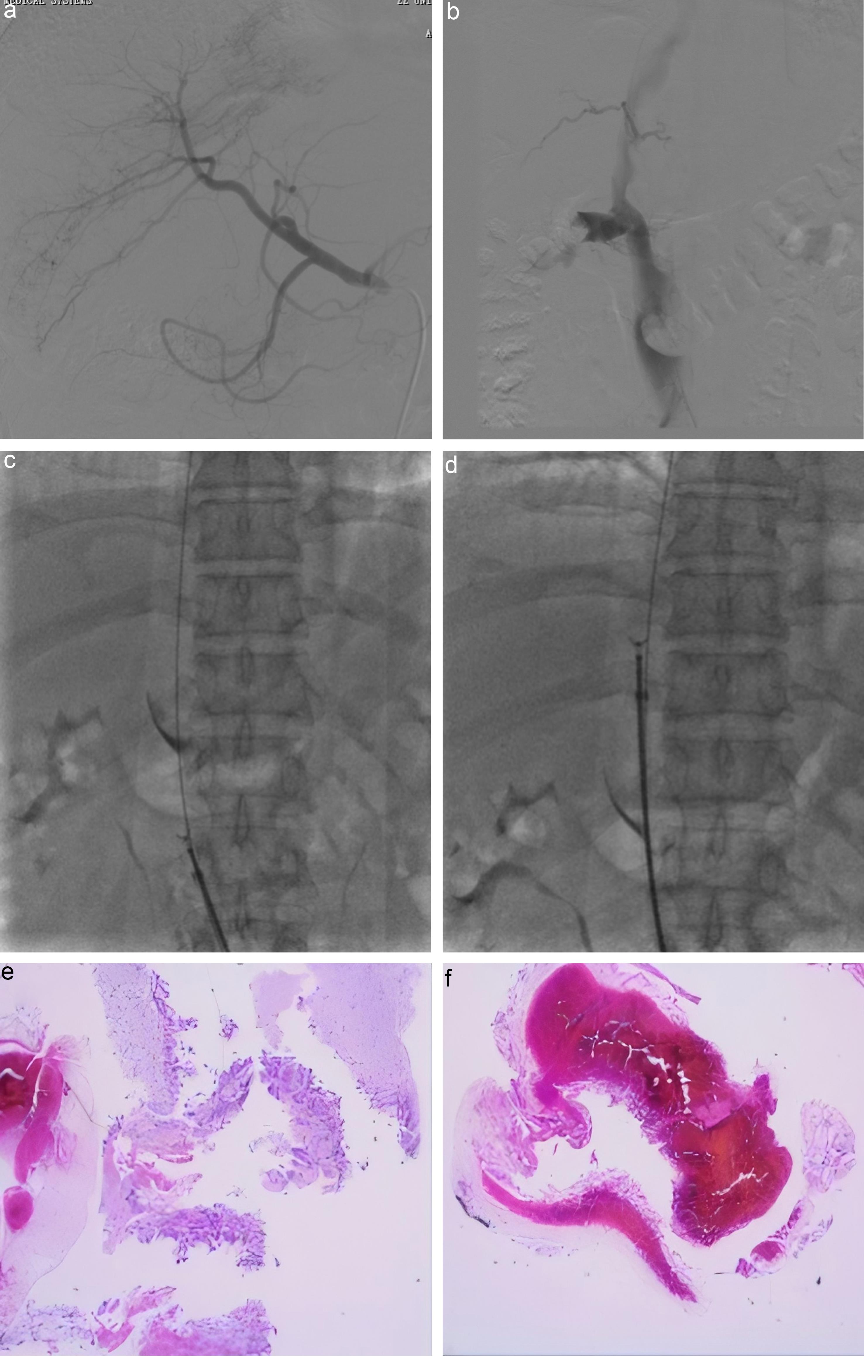 Intraoperative angiography and biopsy processes.