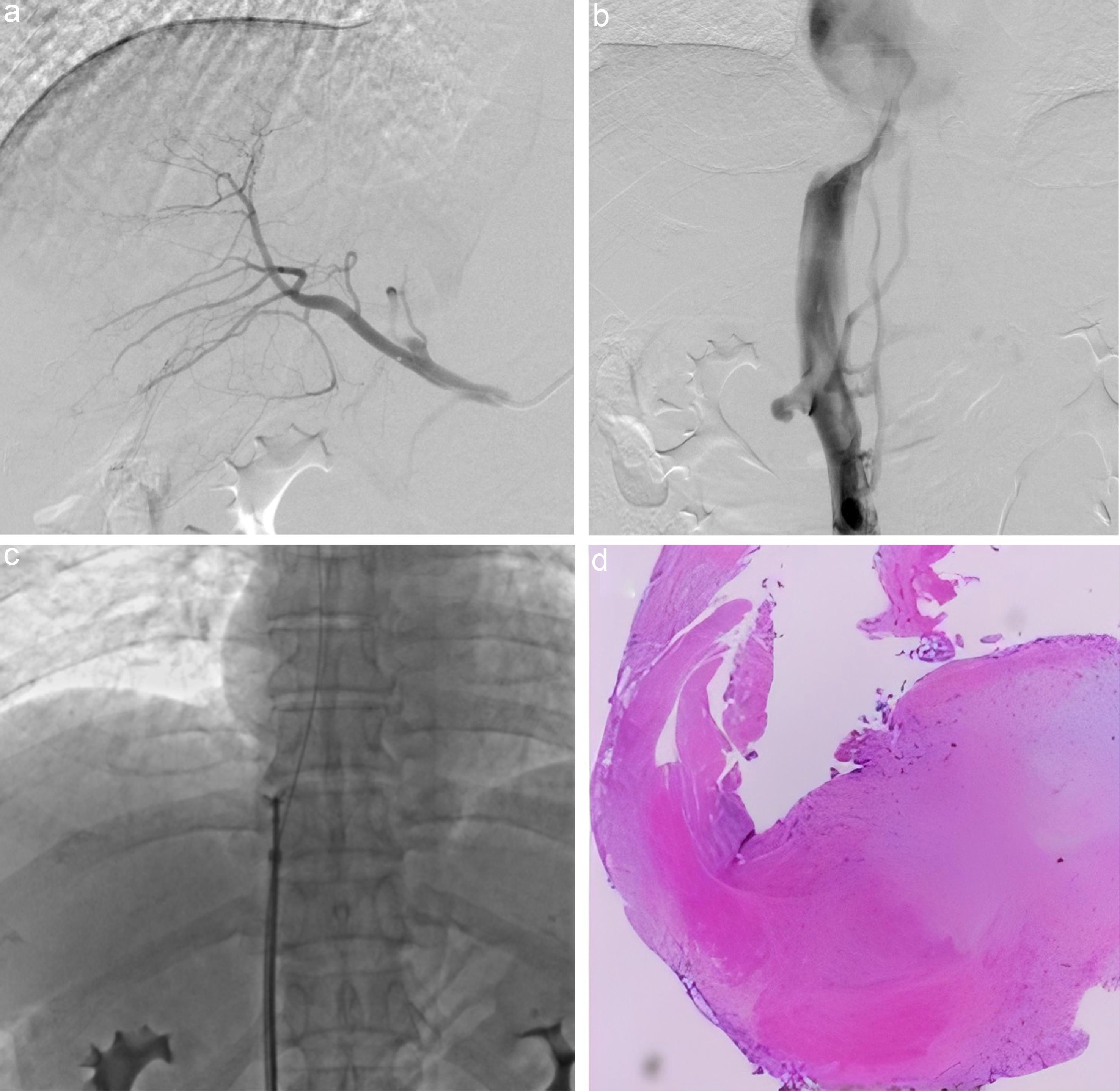 Angiography and follow-up biopsy findings obtained at 3 months postoperatively and following thrombolytic therapy.