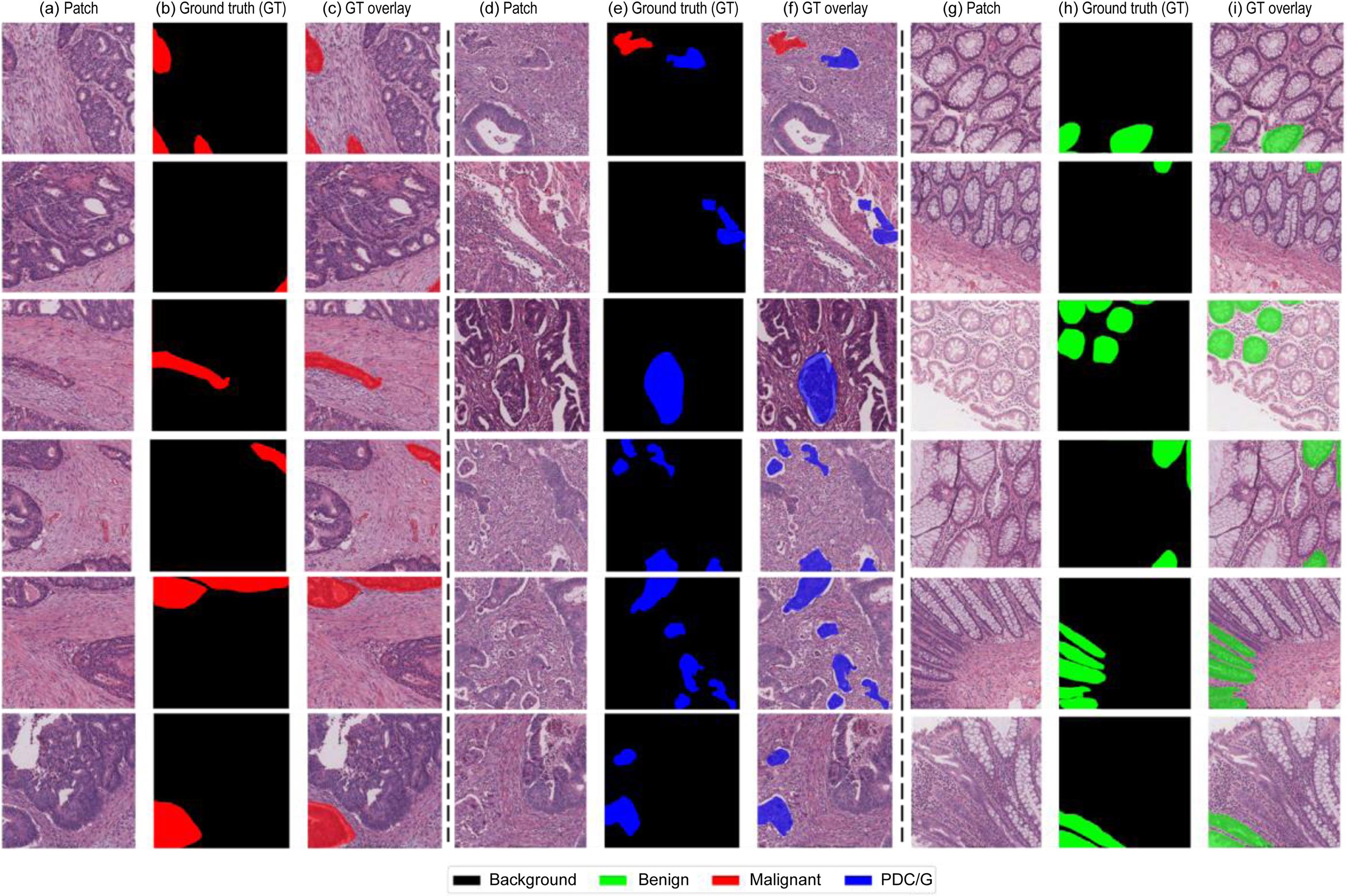 Representative samples from the in-house The Ohio State University Wexner Medical Center (OSUWMC) dataset, illustrating sparse annotations provided by pathologists for three key gland classes: benign glands, malignant glands, and poorly differentiated clusters/glands (PDC/G).