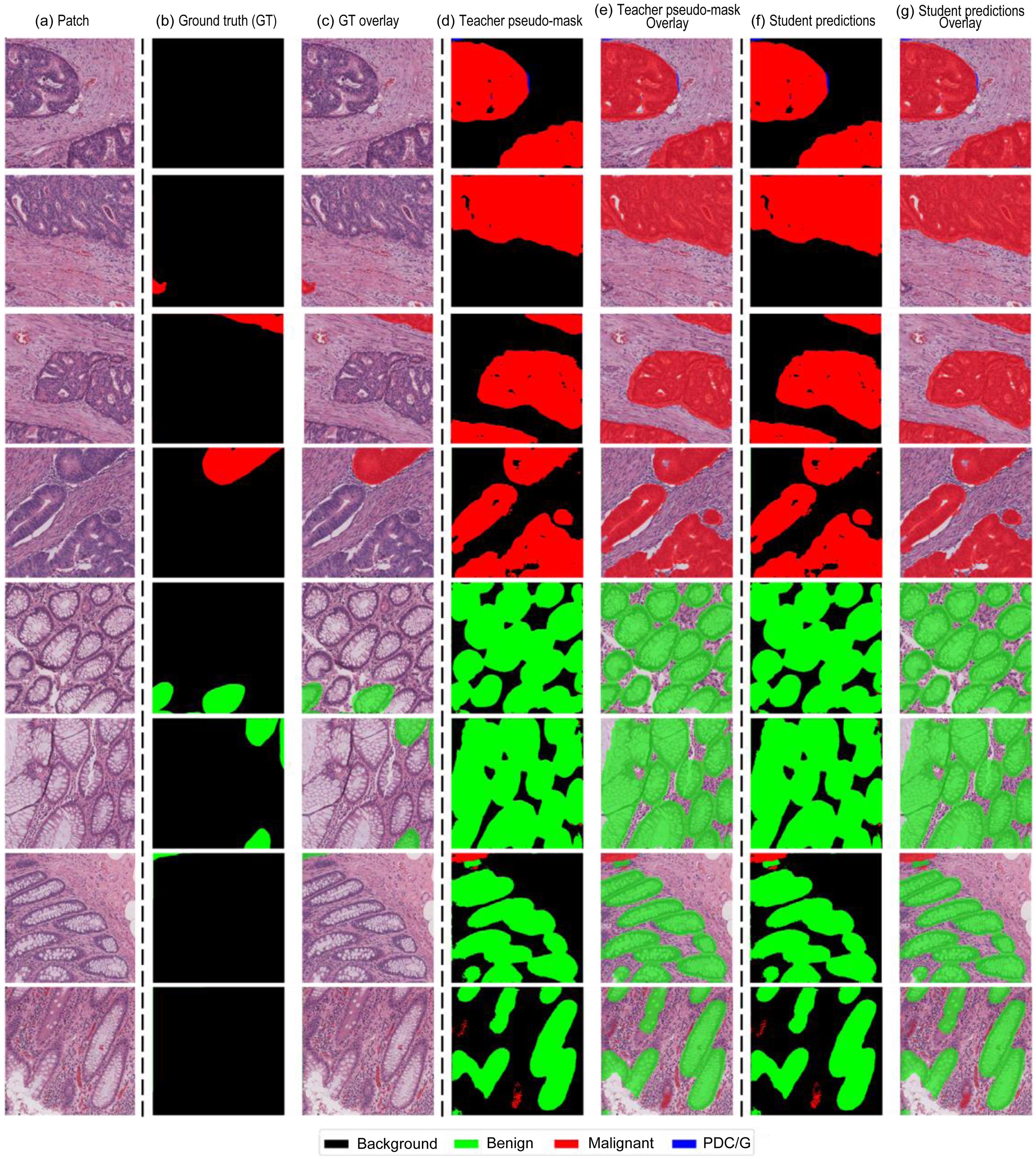 Qualitative segmentation results on the in-house Ohio State University Wexner Medical Center (OSUWMC) dataset.