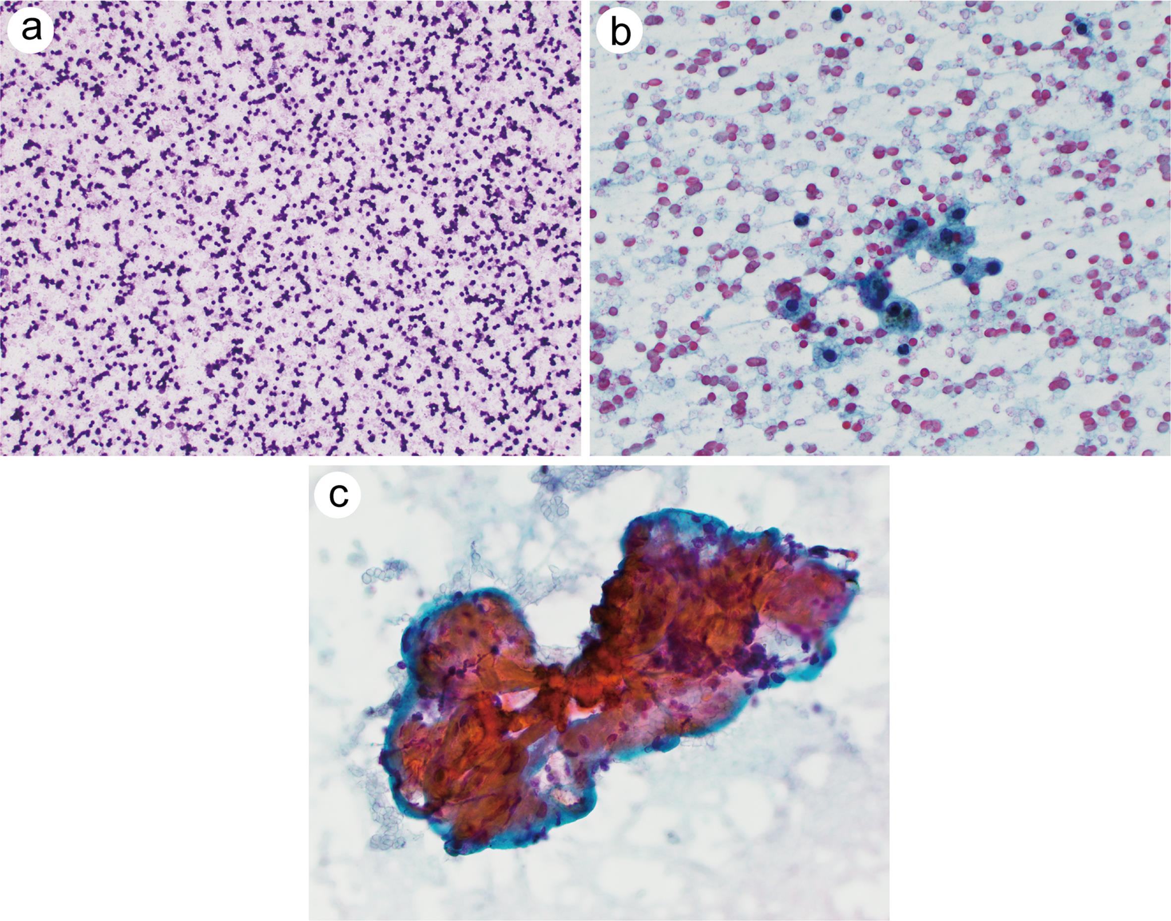 Bethesda System For Reporting Thyroid Cytopathology–An Updated Review