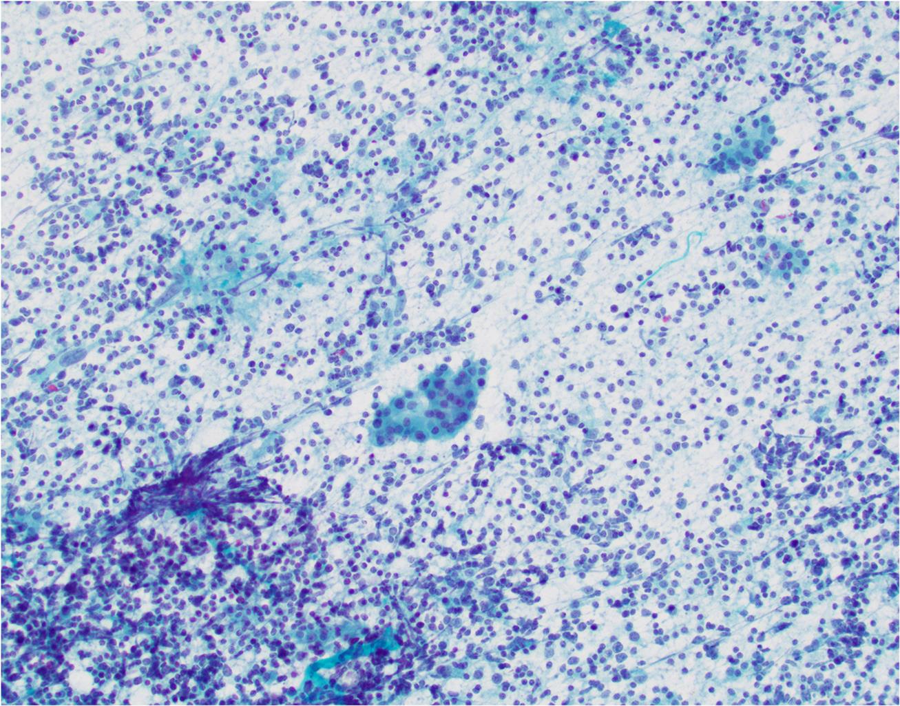 Bethesda System for Reporting Thyroid Cytopathology–An Updated Review