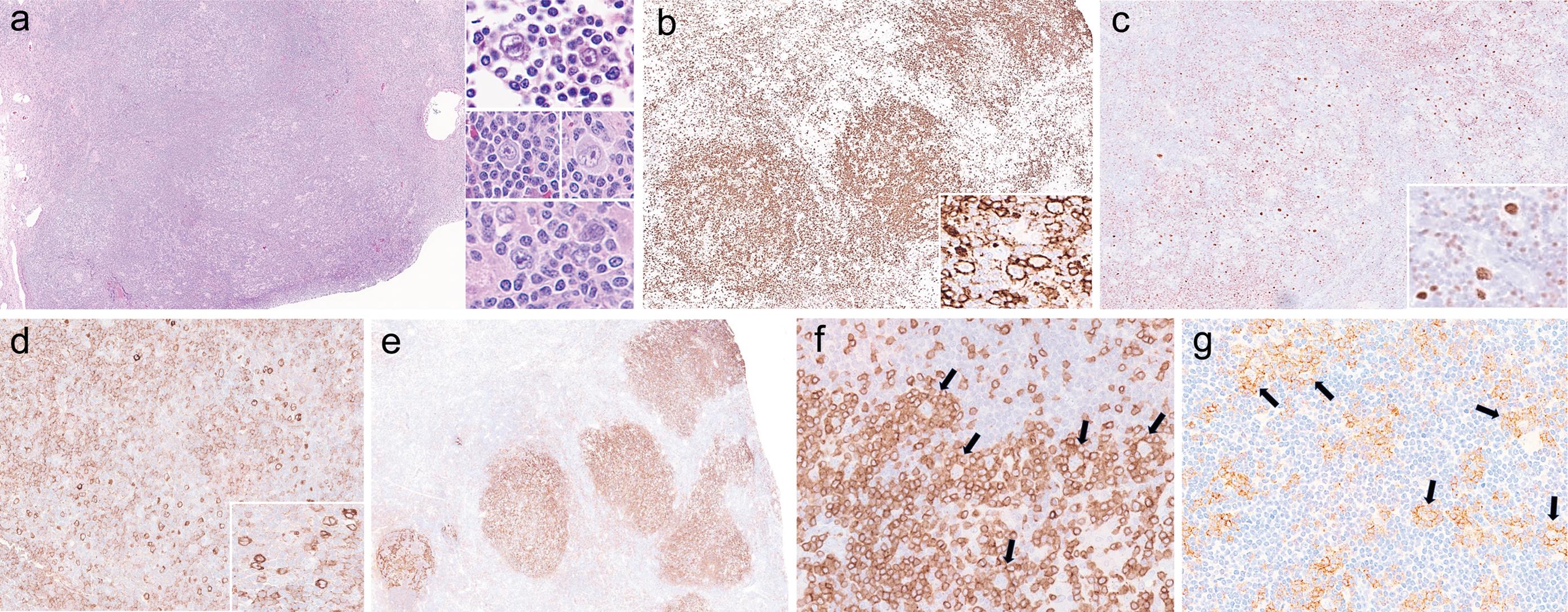 The histologic and immunohistochemical features of NLP.