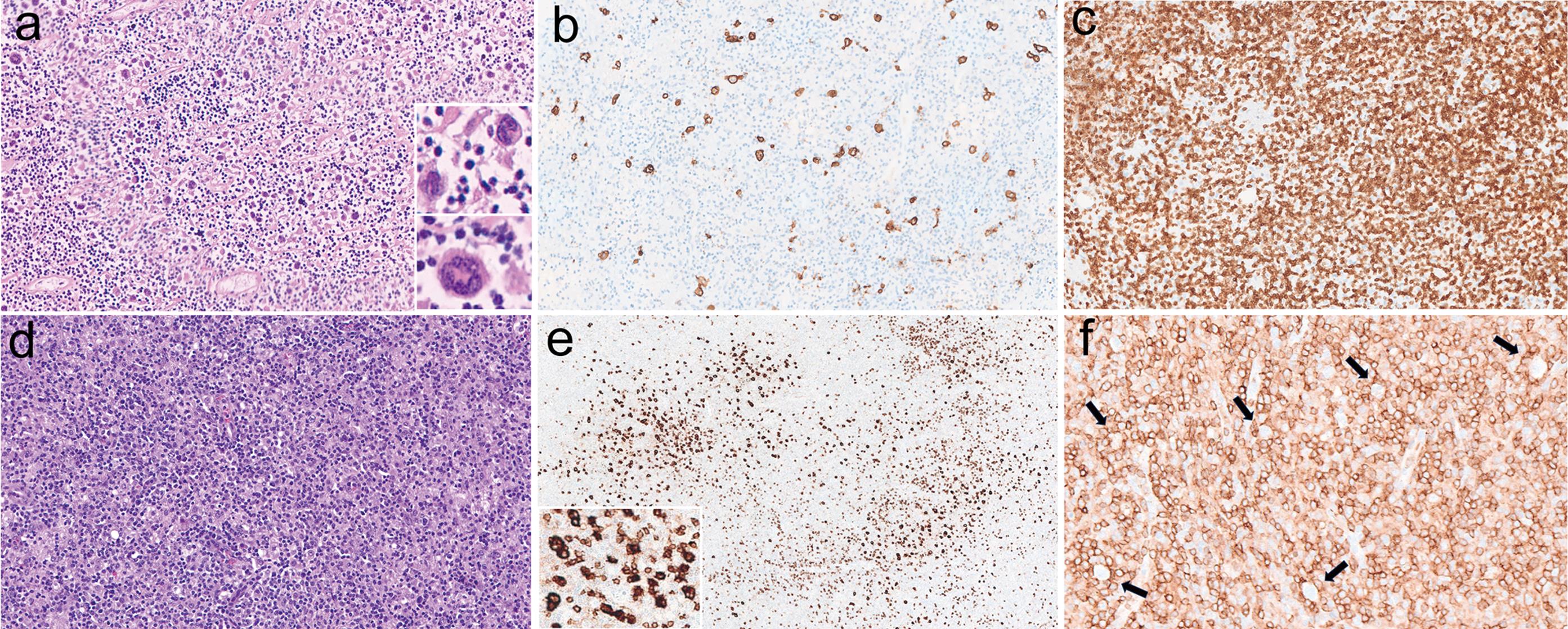 The histologic and immunohistochemical features of THRLBL vs. NLP Fan pattern E.