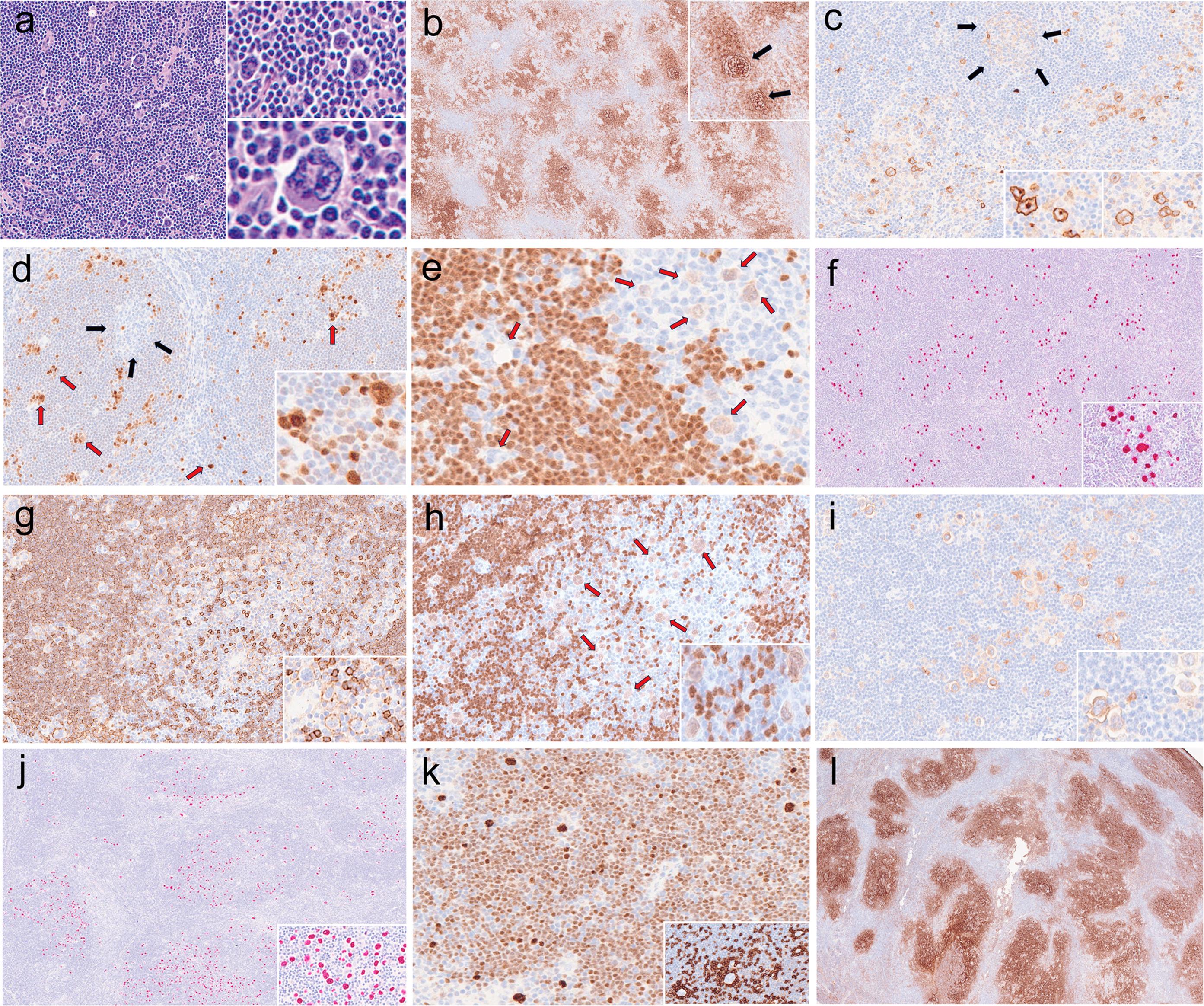 The histologic and immunohistochemical features of LRCHL vs. EBV+ NLP.