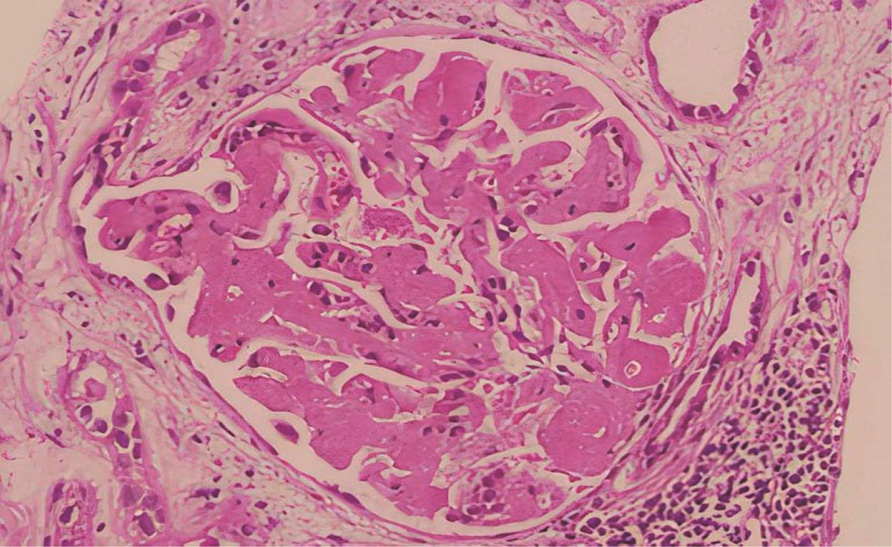 Pathological findings of biopsied renal tissue.