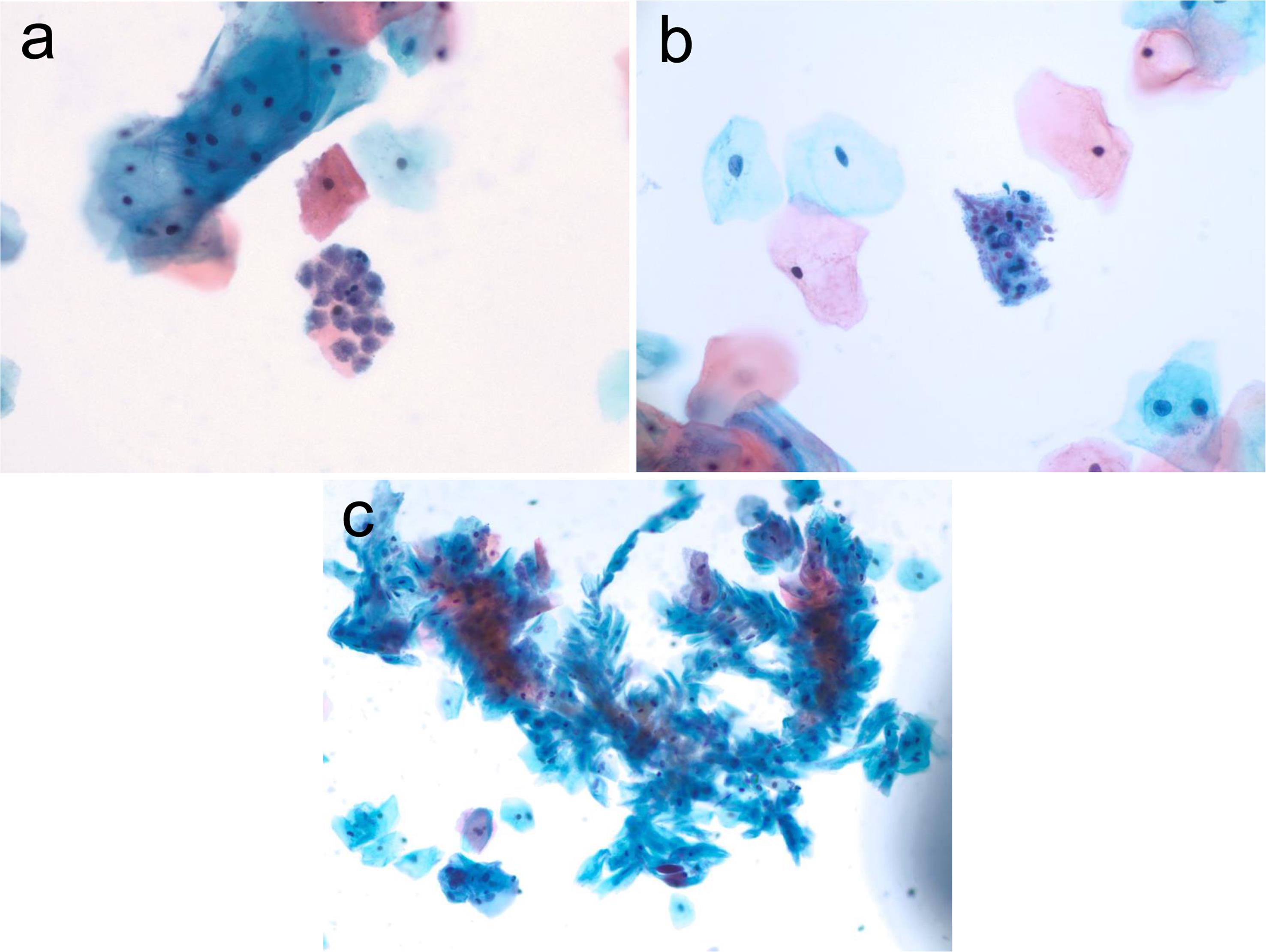 Infection showing the hyphae with “shish kabob” cytomorphologic features.