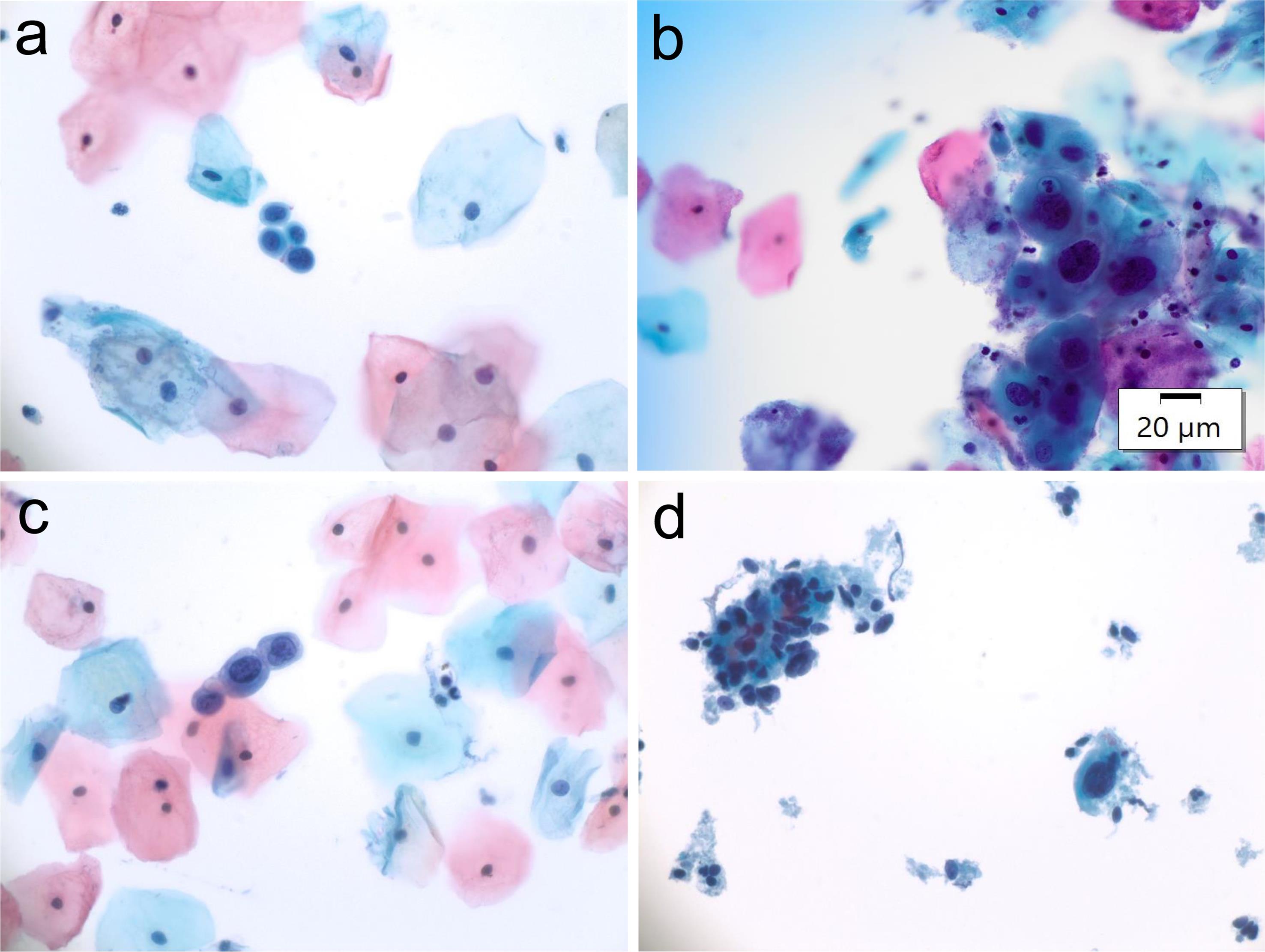 ASC-H cells with enlarged nuclei, and the relatively remaining N/C ratio (a–d).