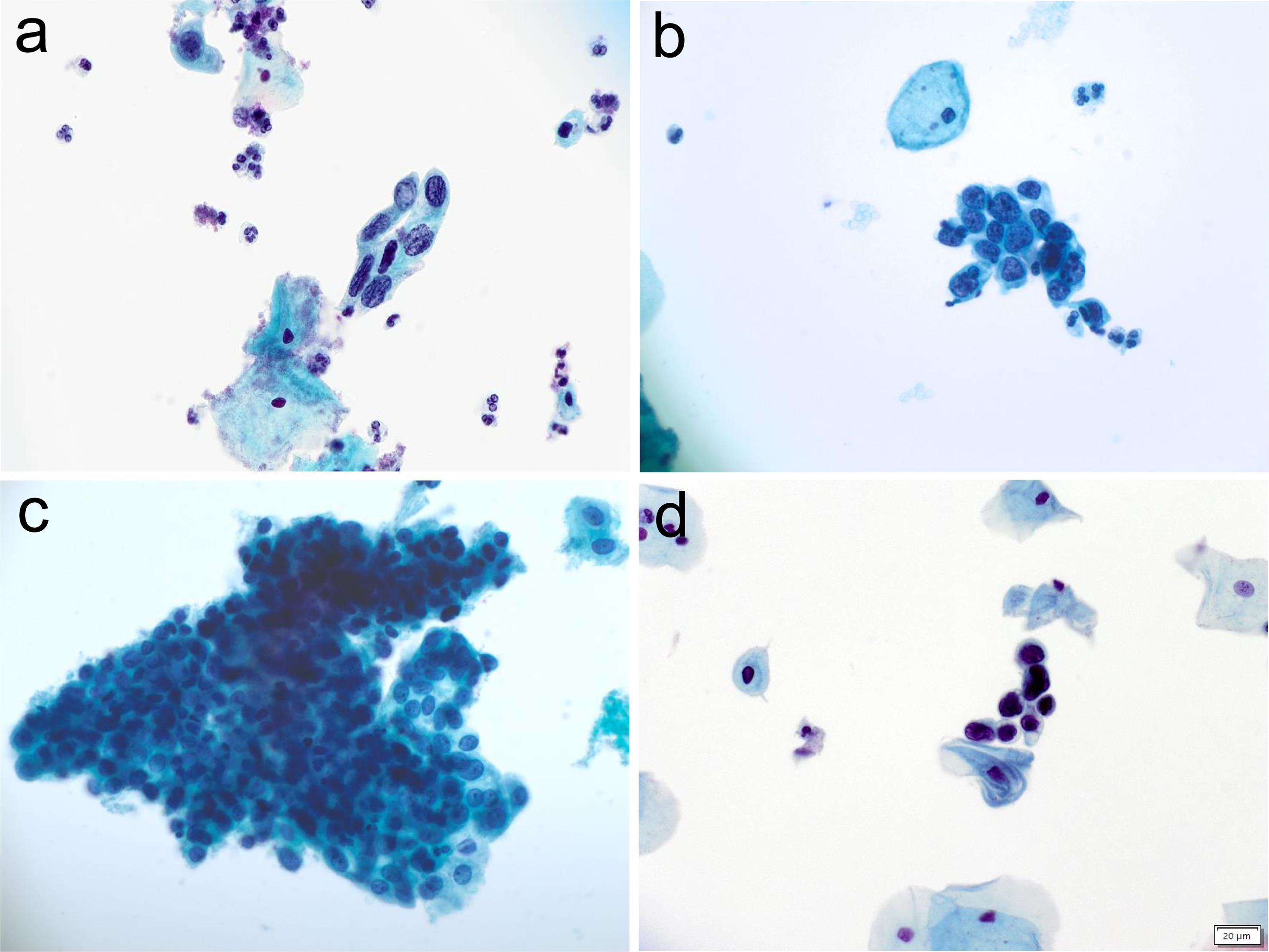 HSIL cells with a high N/C ratio, hyperchromatic nuclei, and occasionally dispersed single cells (a–d).