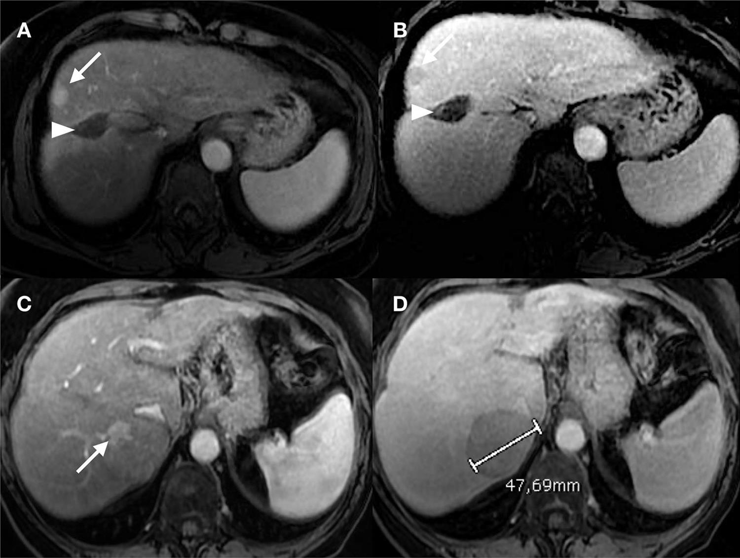 Particular cases of LR-5 on MRI.