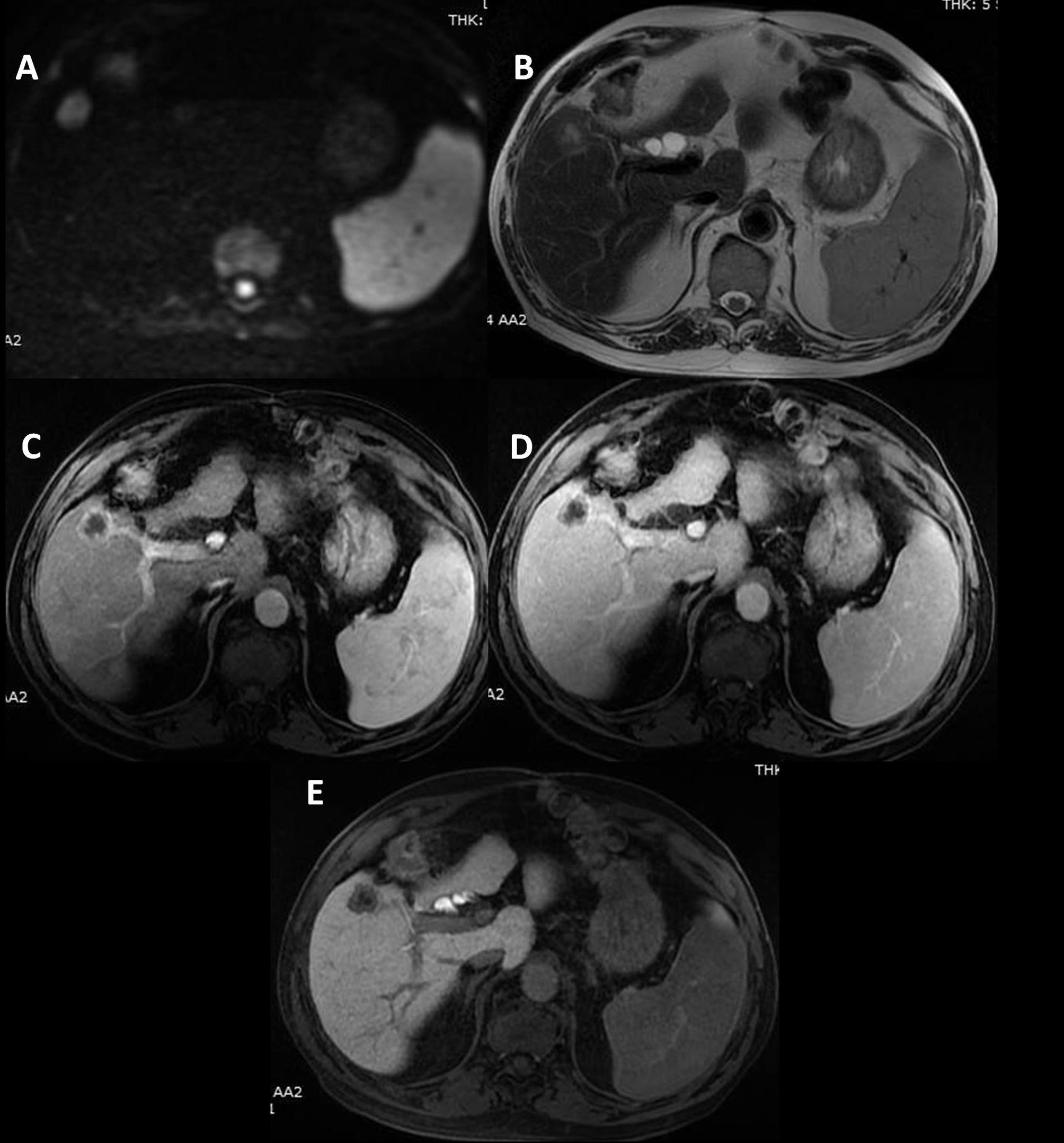 A 69-year-old man with hepatitis C cirrhosis, already treated for HCC in the past, who was referred for magnetic resonance imaging after the detection of a 25-mm hypoechoic nodule in his regular ultrasound follow-up.