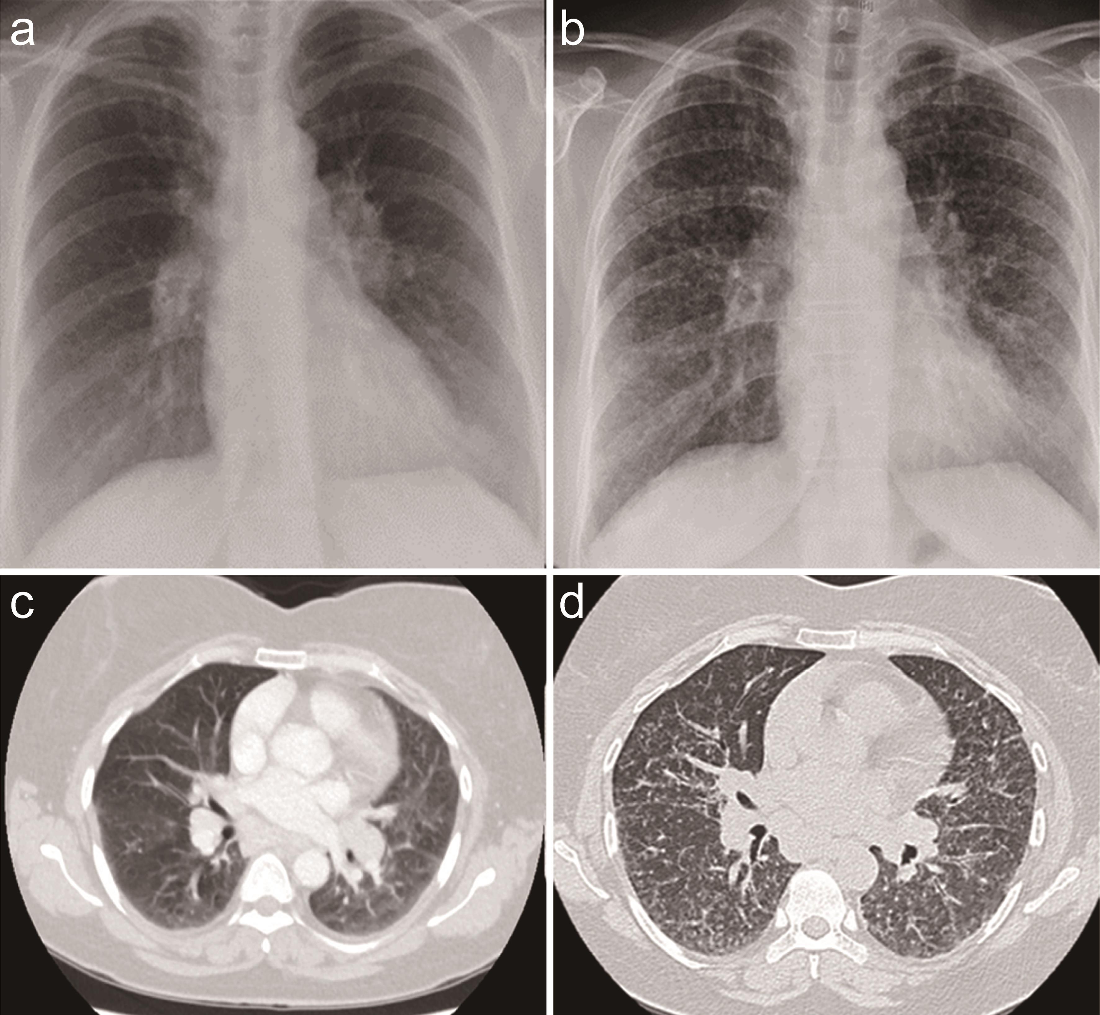 Initial CXR (a) and HRCT (c) chest showed bilateral lymphadenopathy. CXR (b) and HRCT (d) of the chest performed a year later showed a miliary pattern along with bilateral lymphadenopathy.