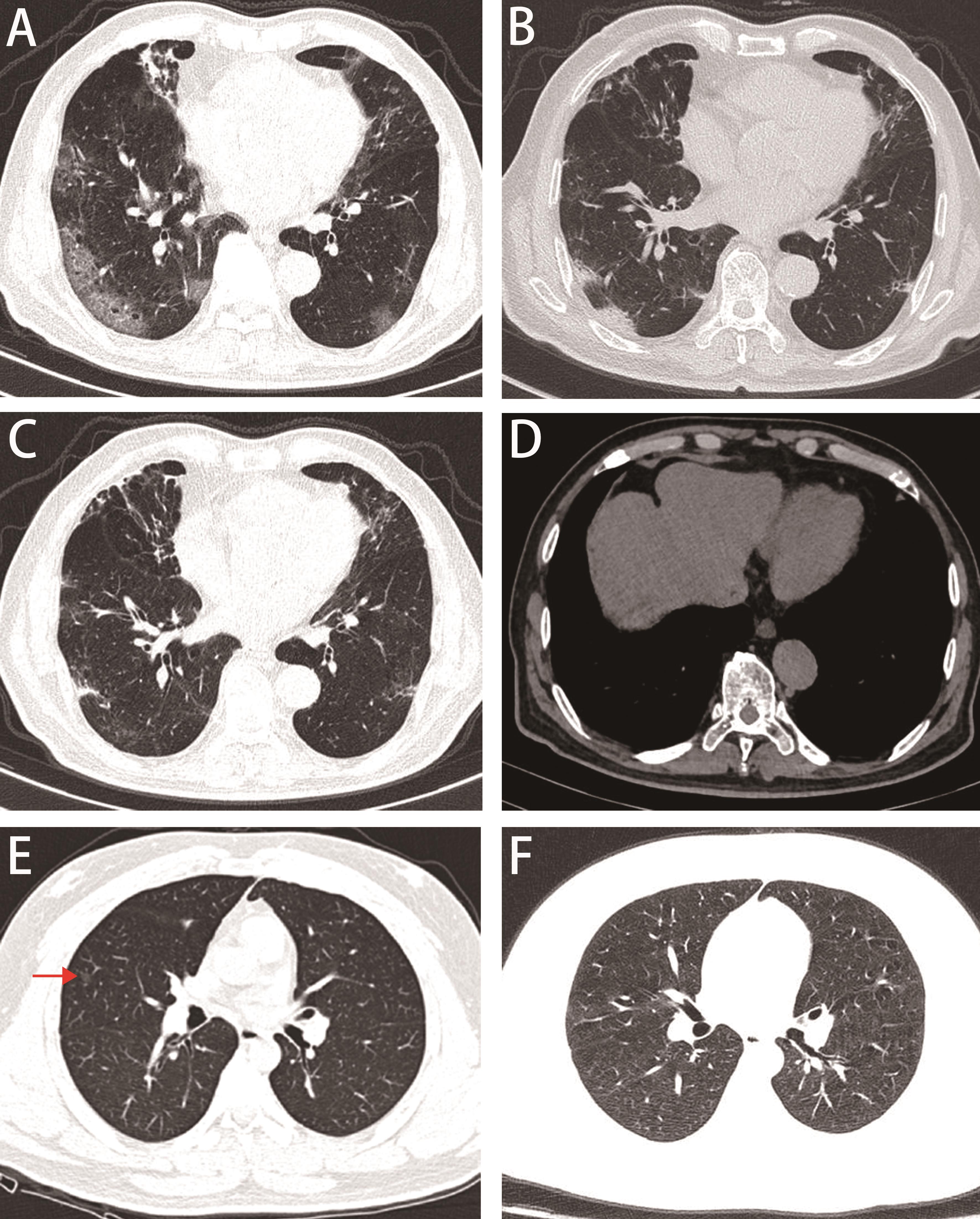 Lung and abdomen CT scans of case 1 and case 2.