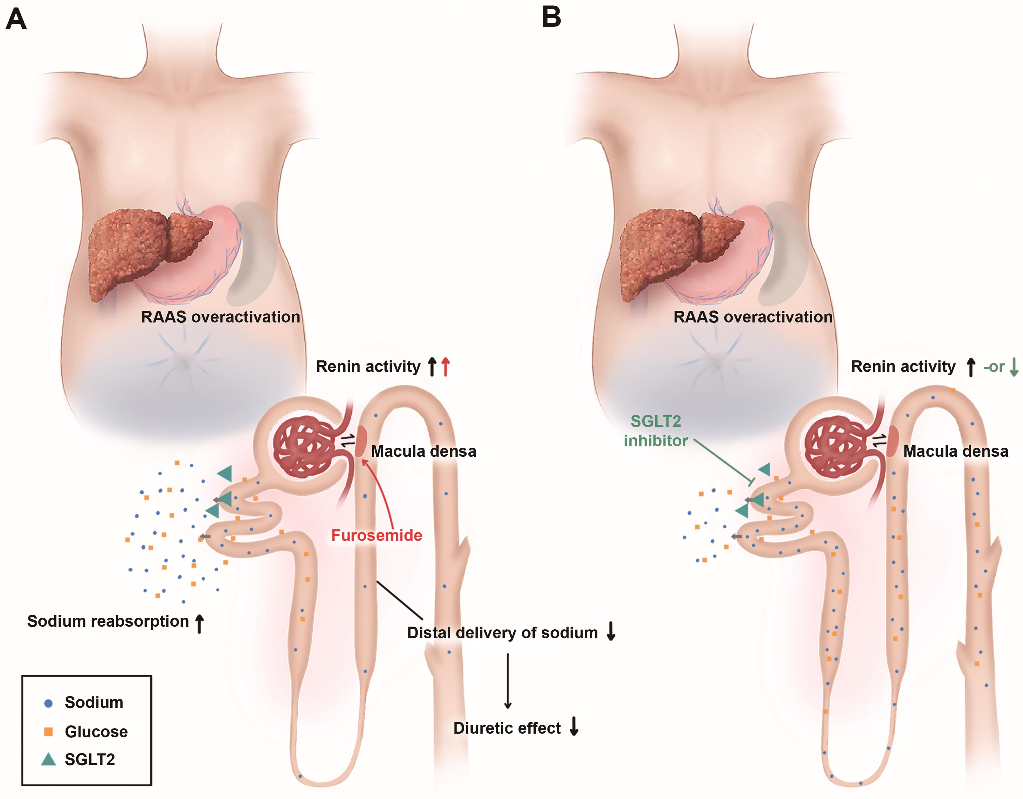 Pathophysiology of cirrhotic ascites and the mechanism of action of SGLT2 inhibitors.
