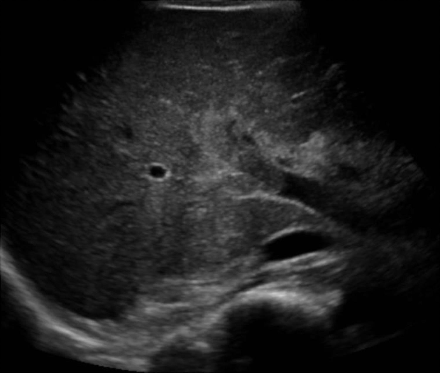 Filling defect in the portal vein on ultrasound.
