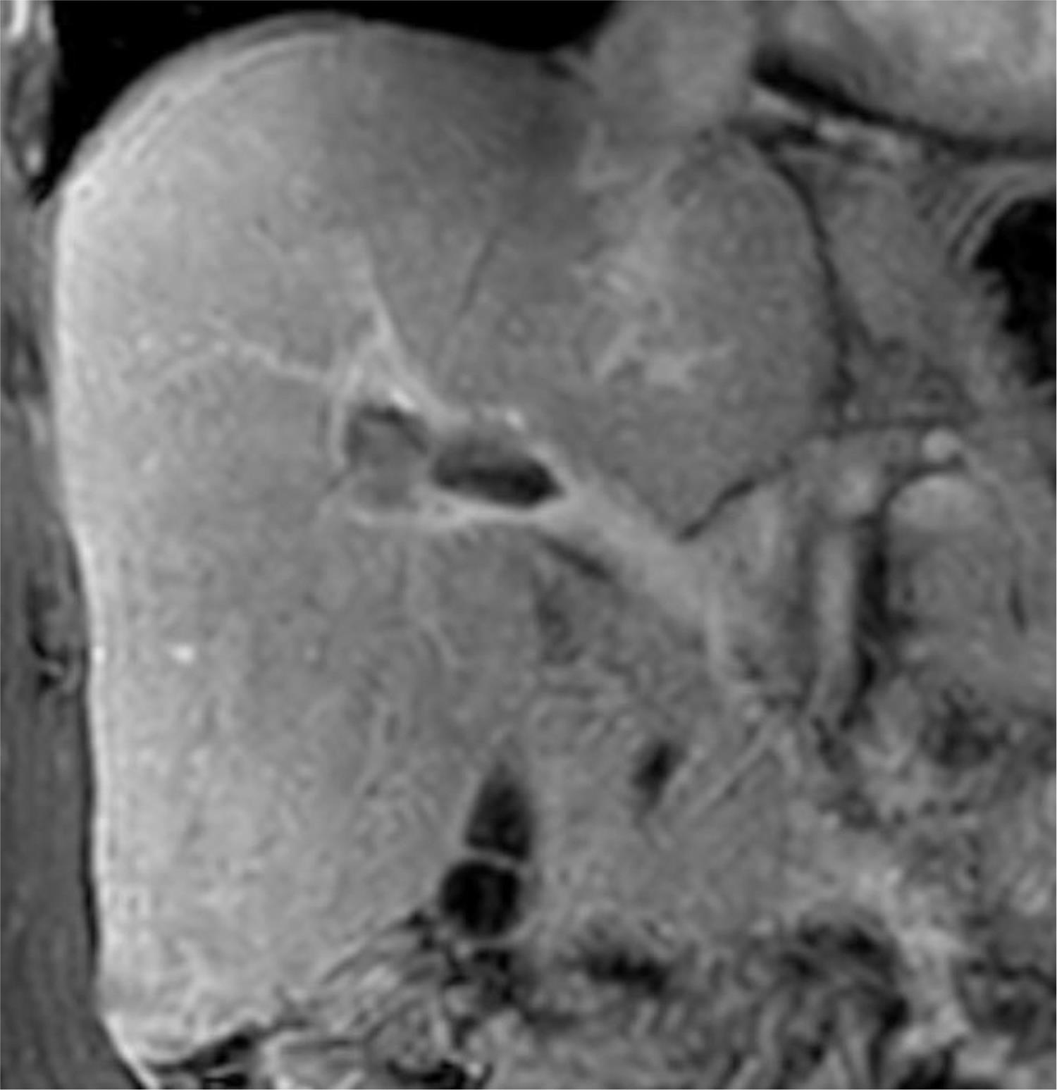 Filling defect in the right portal vein, coronal LAVA magnetic resonance imaging sequence.