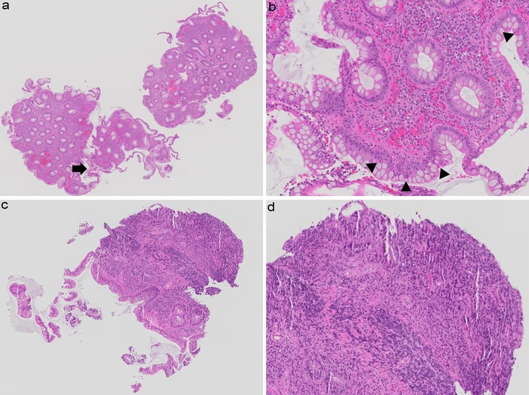 Discrepancy in Nancy index grading of hematoxylin and eosin-stained biopsy images by pathologists.
