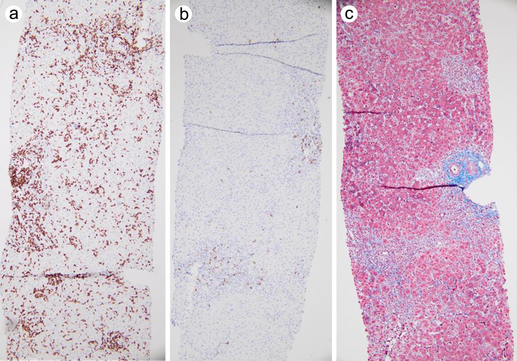 Immunostains and trichrome stain of liver biopsy.